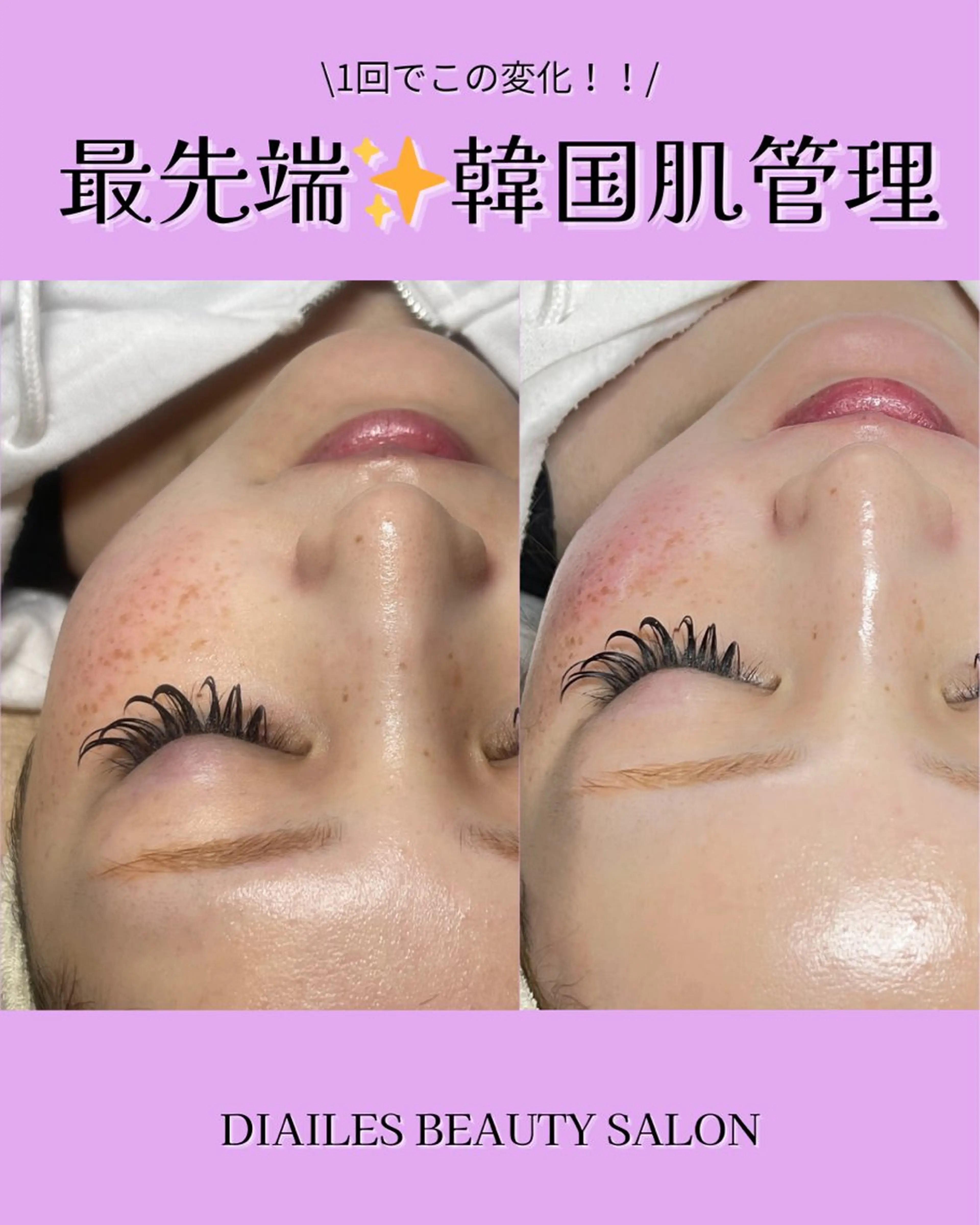 💎ダイヤモンドピール💎渡韓不要水光肌に🫧⏰60分の写真