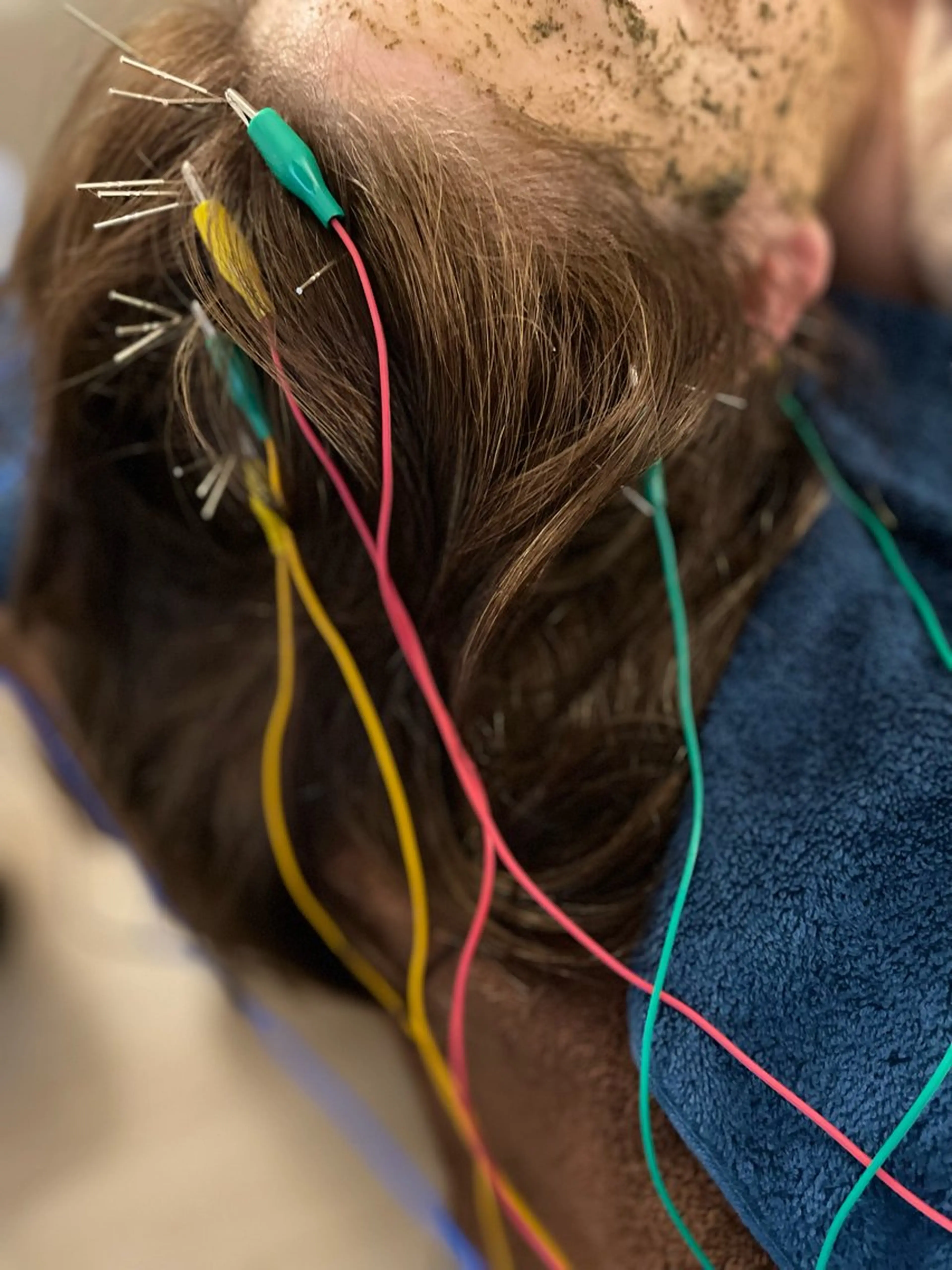 美楽鍼 びらくしんのその他イメージ