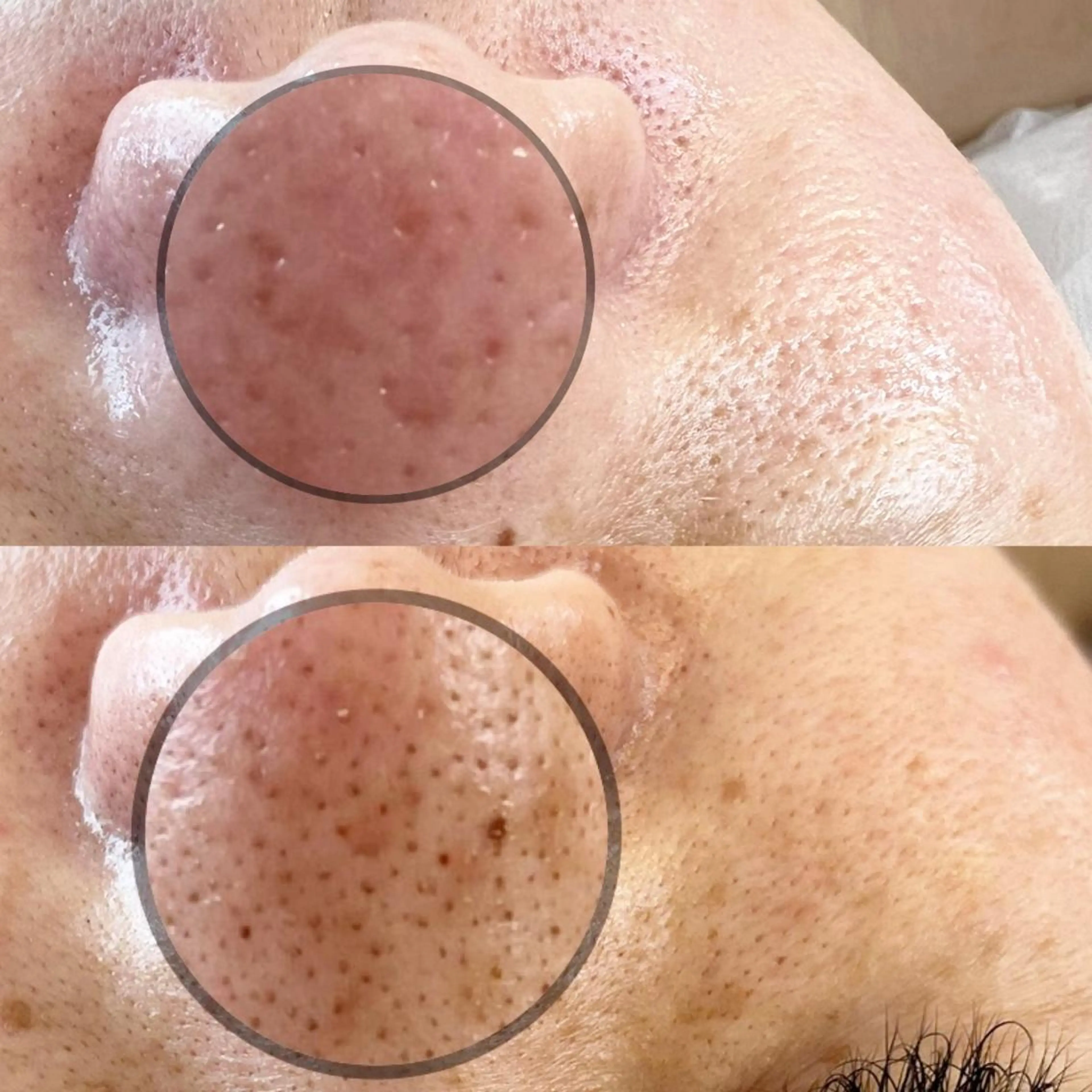 ❤️ミニモ限定特別価格❤️毛穴の黒ずみ角栓徹底除去!!エクストラクション【鼻or顎】集中ケア✖️Tゾーンワックス脱毛付きの写真