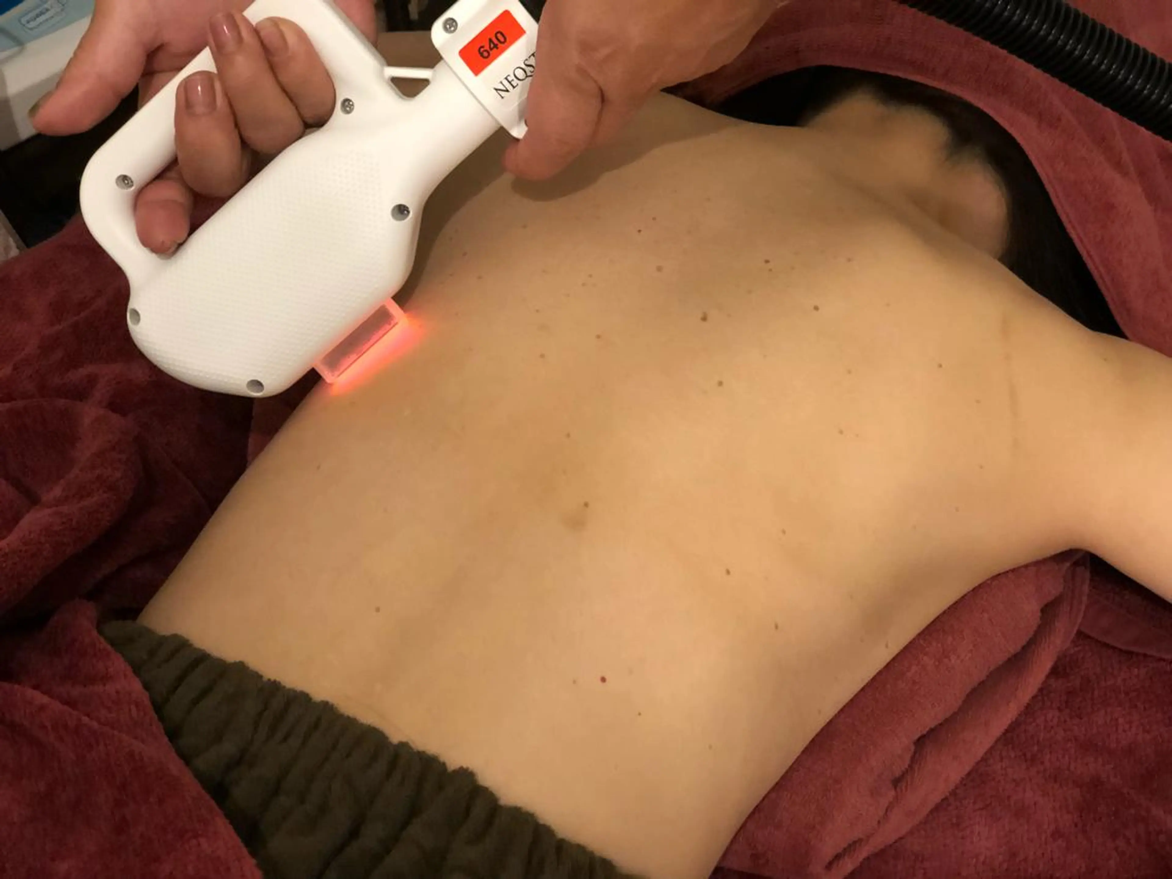 ツルツル美肌脱毛両ワキ＋ひざ下の写真