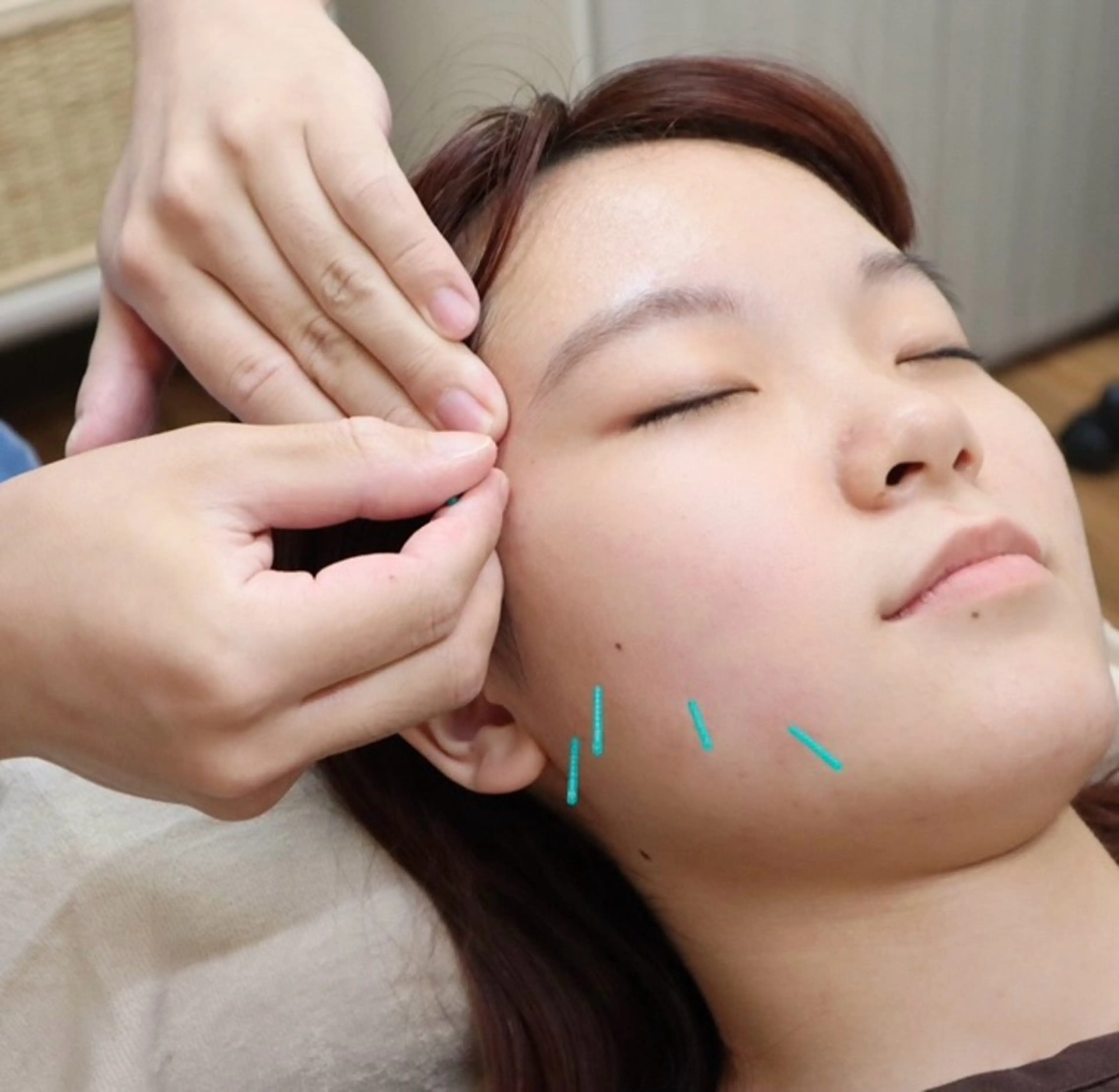 【ミニモ学割U23】小顔&むくみスッキリ✨《美容鍼+カウンセリング お試しコース》の写真
