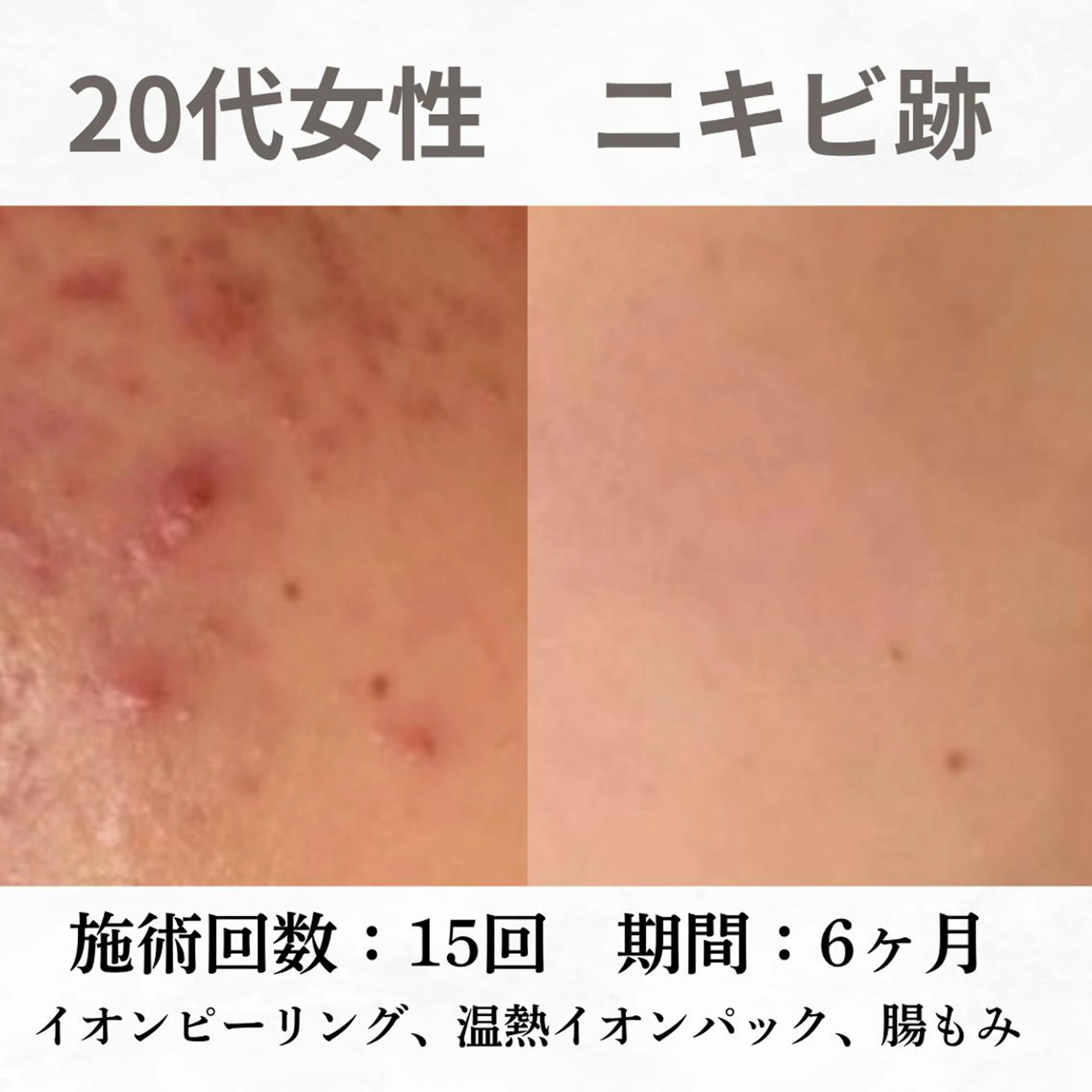 重度ニキビ専門🌷 ダウンタイムなしのエステ・リラクイメージ