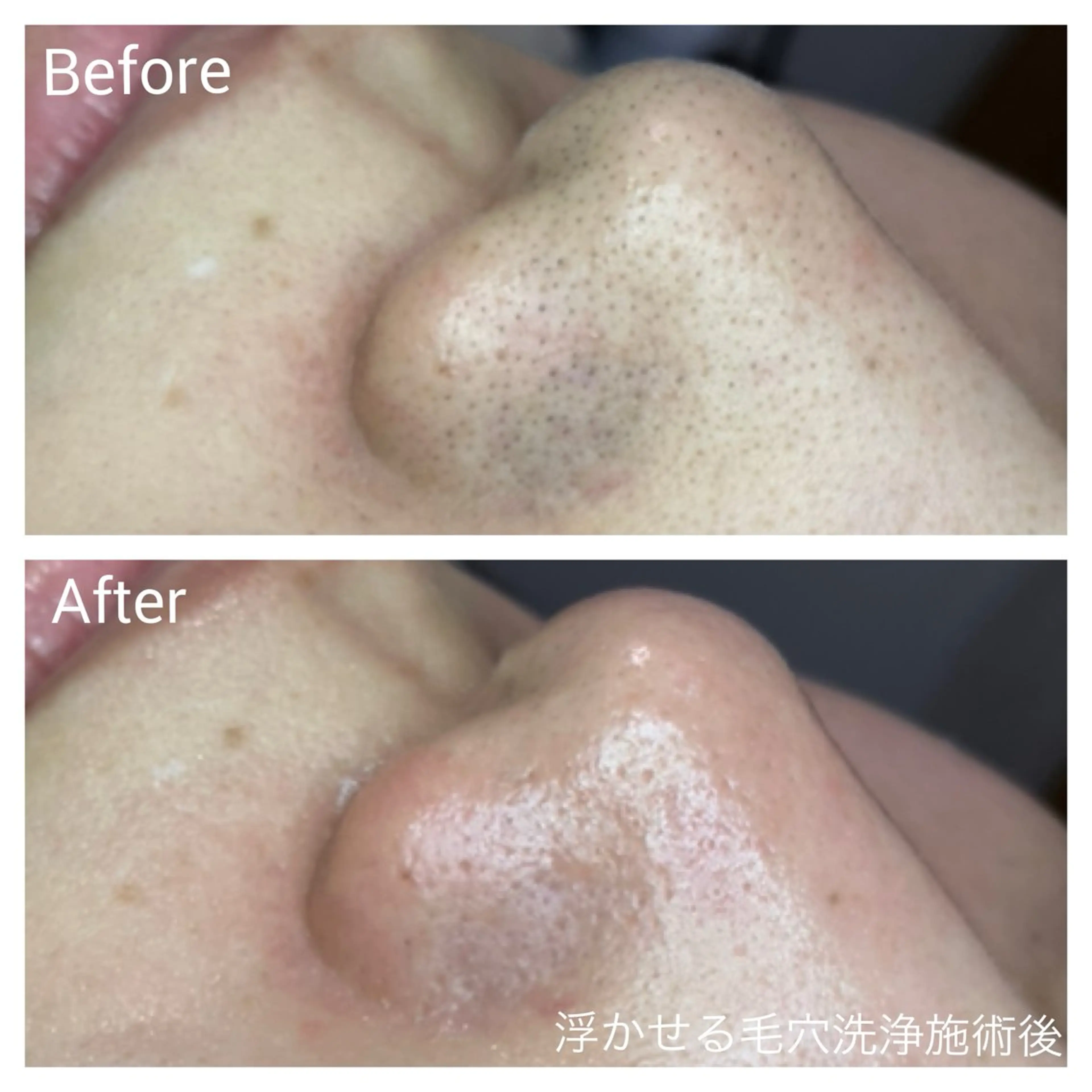 ⭐️人気⭐️即効果実感❣️【頑固な黒ずみ・角質角栓に】浮かせる毛穴洗浄3パーツ(鼻・顎・眉間)フェイシャル45分の写真