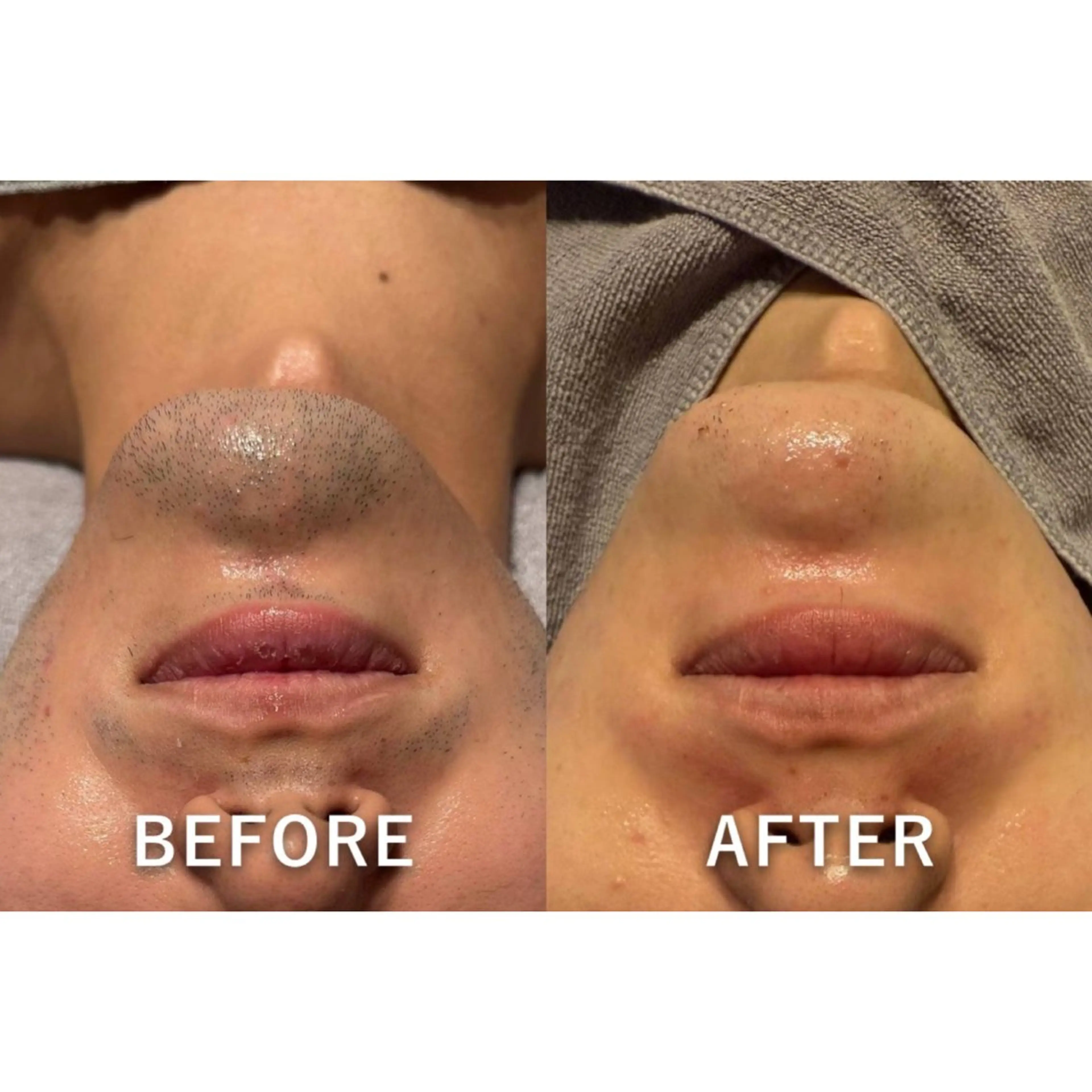 【男性必見👀🌟】ヒゲ脱毛｜朝の髭剃り時間を短縮したい方に!!の写真