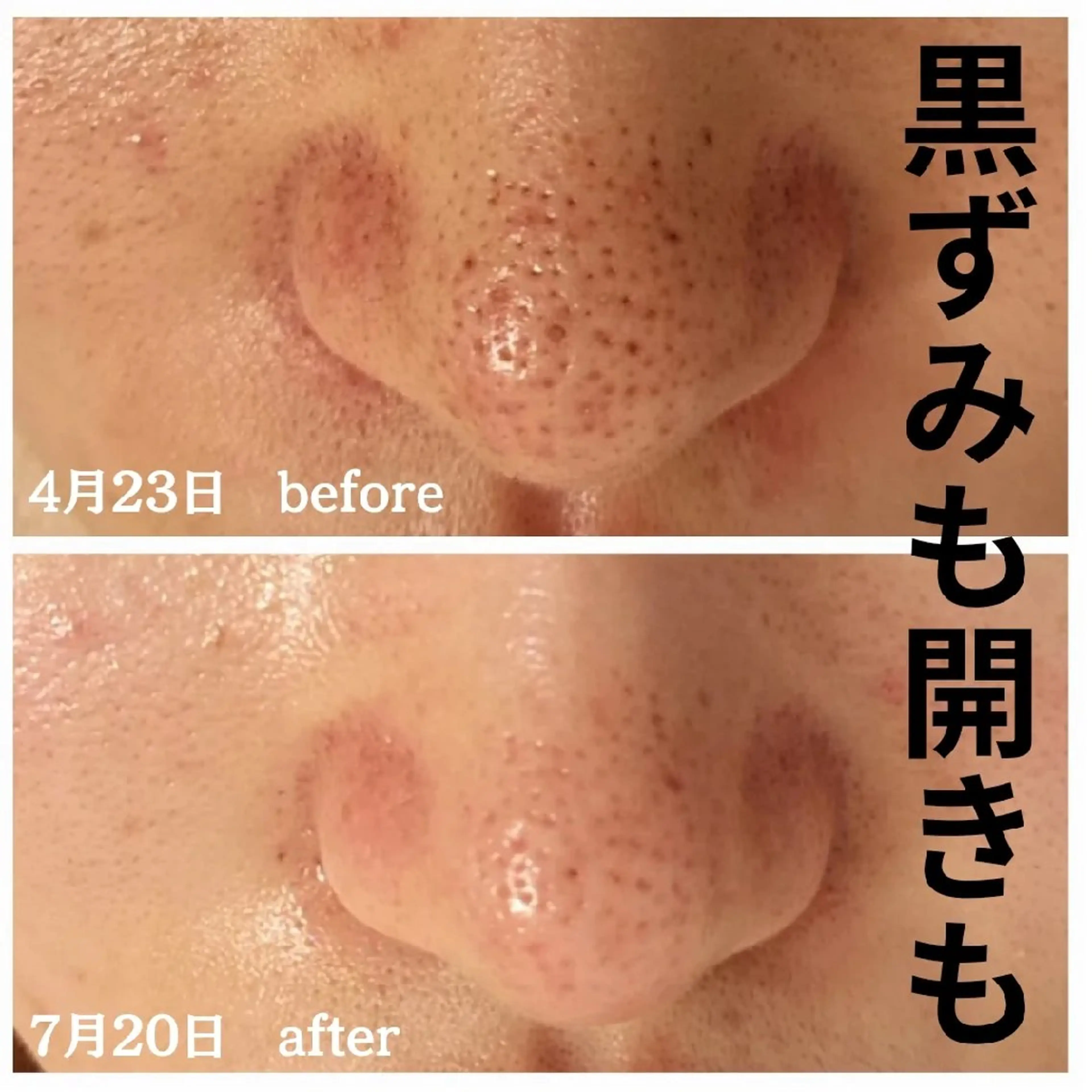 毛穴洗浄&マッサージ+高濃度美容液導入　60分　￥3,300オフの写真