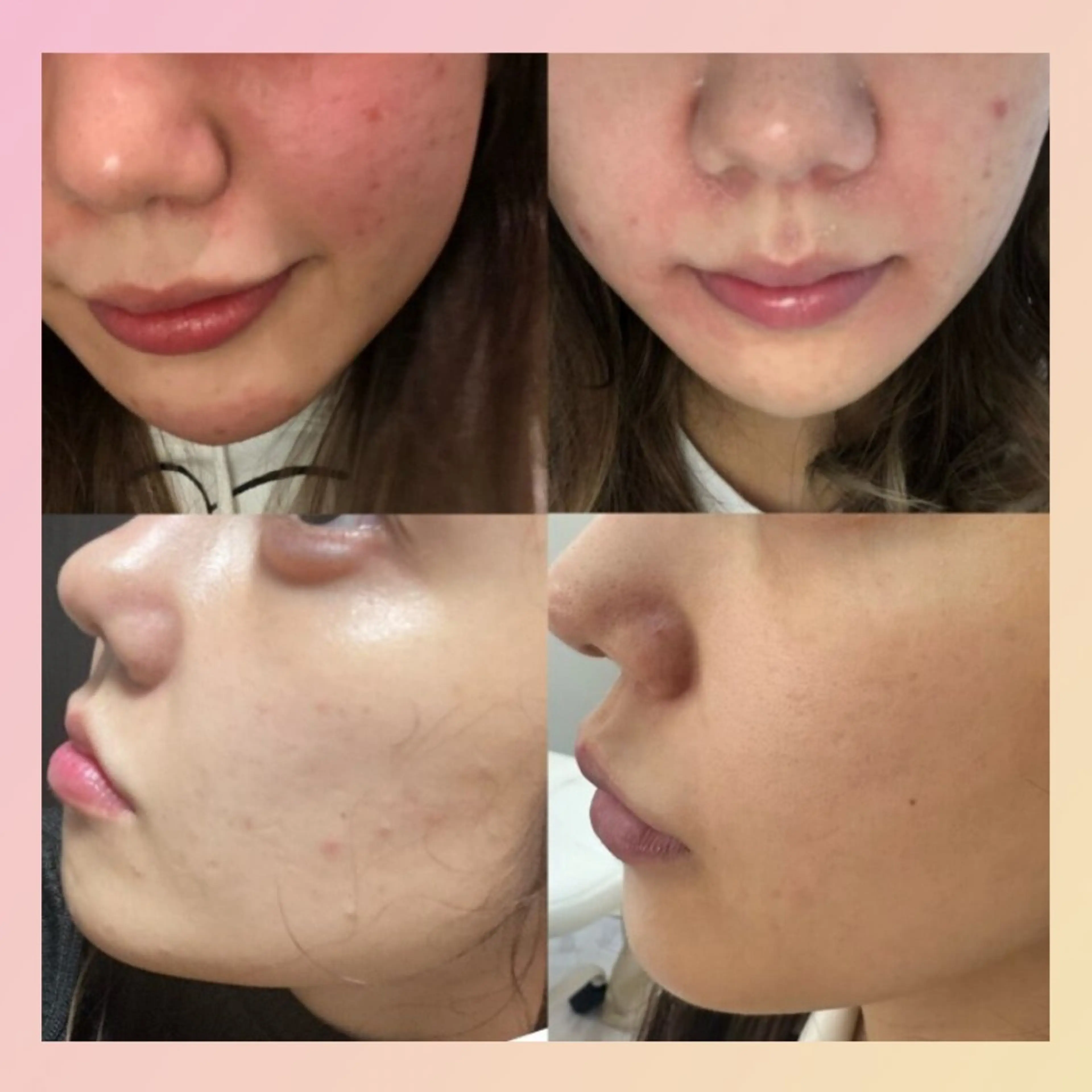 【まずはこちらから♪】ニキビ徹底コース🌟肌再生レストトリートメント¥18,700→¥8,800の写真