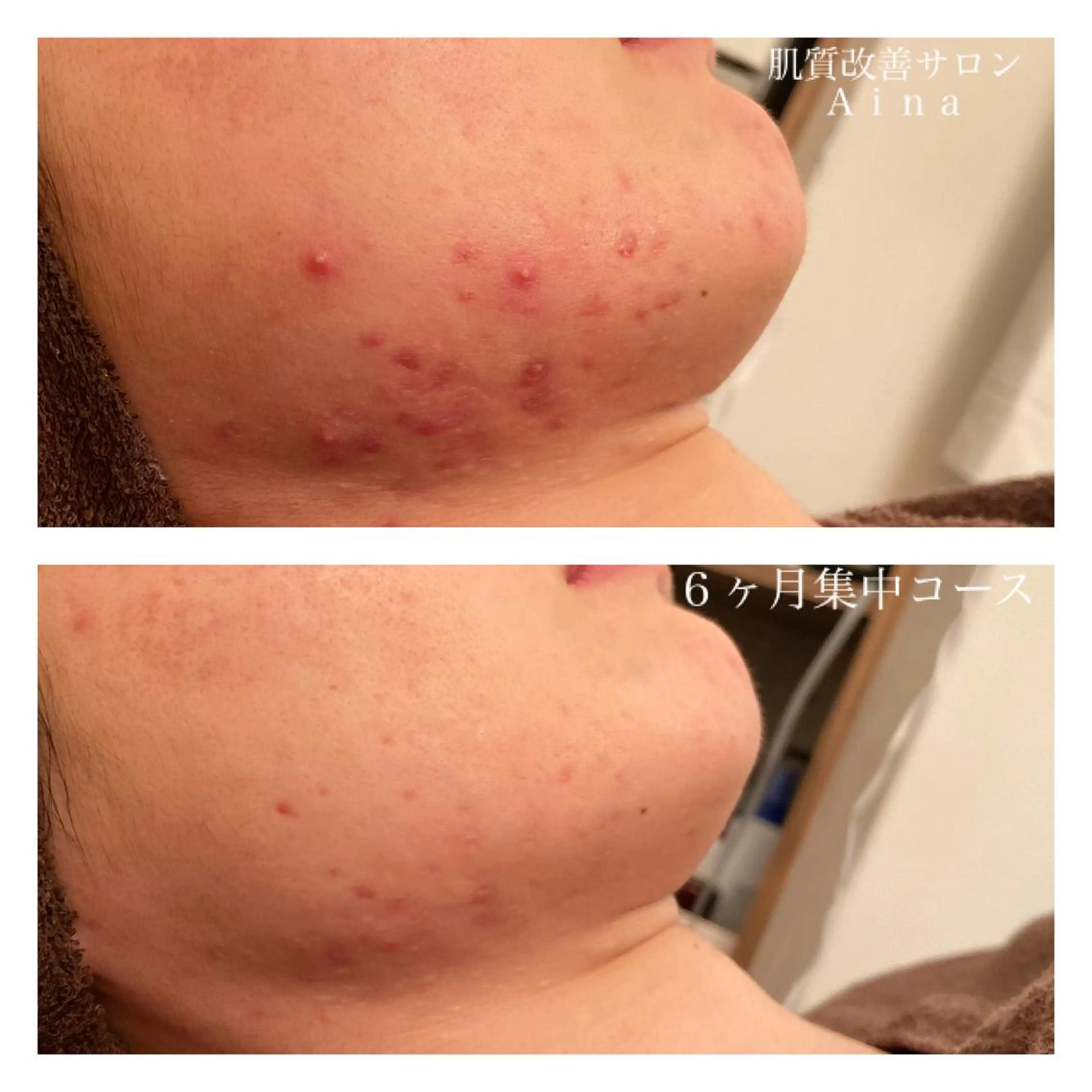 セミロング カラー パーマ ヘアアレンジ メンズ キッズ ネイル マツエク・マツパ エステ リラク ニキビ跡専門サロン Ａｉｎａのエステ・リラクイメージ