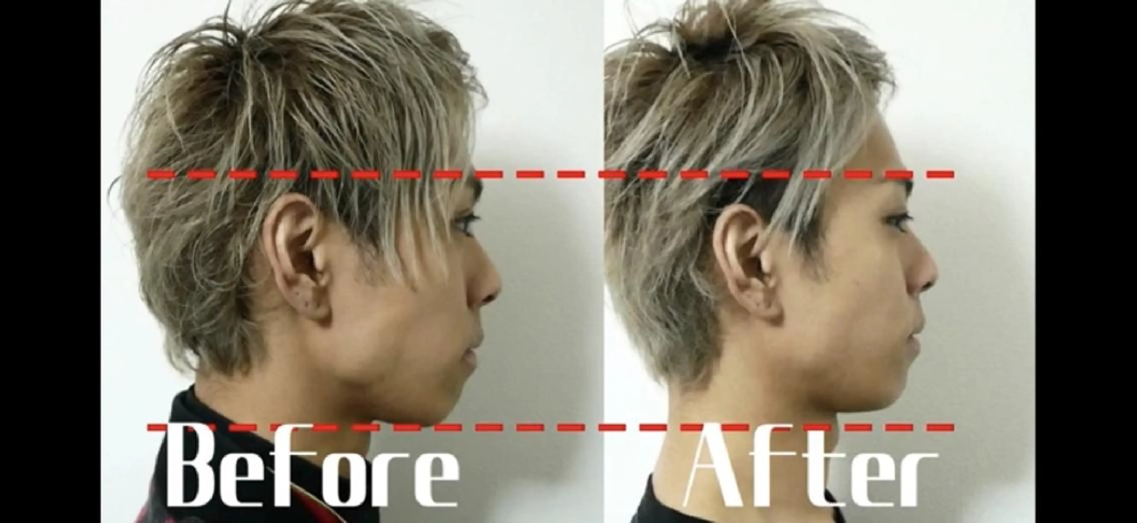 メンズ 医療提携Ruby小顔 ハーブピーリングのその他イメージ