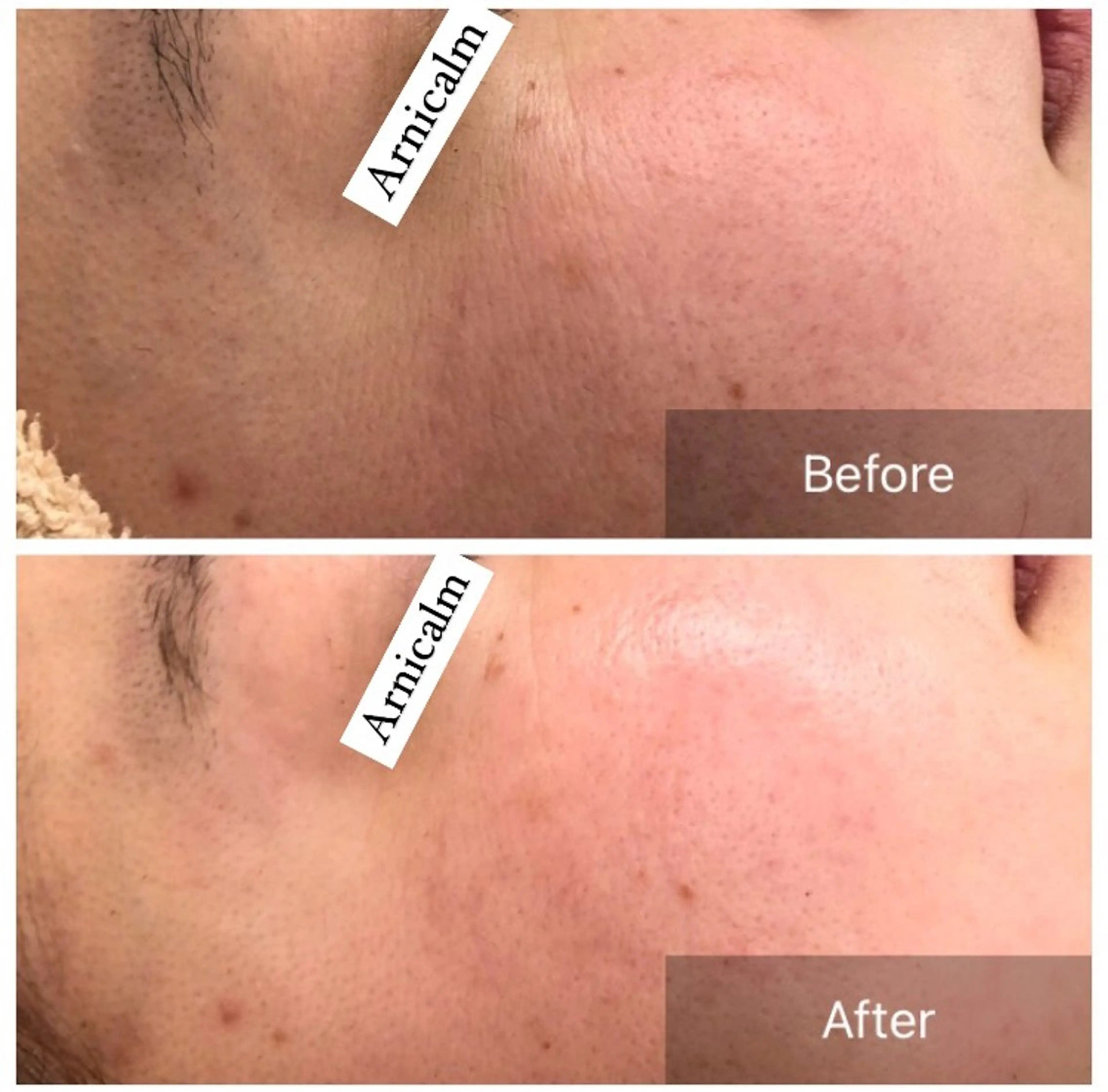 ハーブピーリング 肌再生ピーリング/のエステ・リラクイメージ