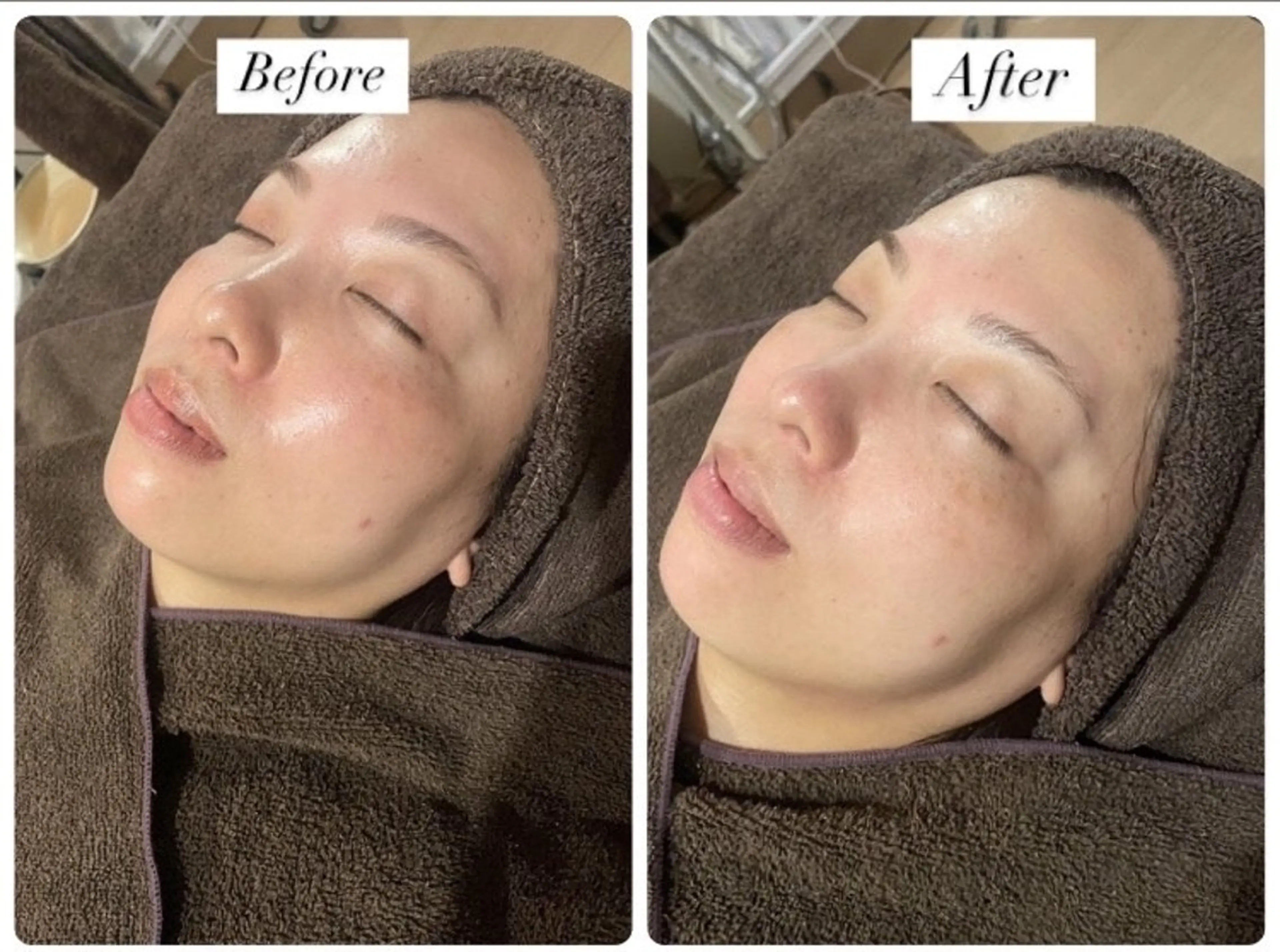 美肌脱毛/肌質改善 《ulula～梟》のエステ・リラクイメージ