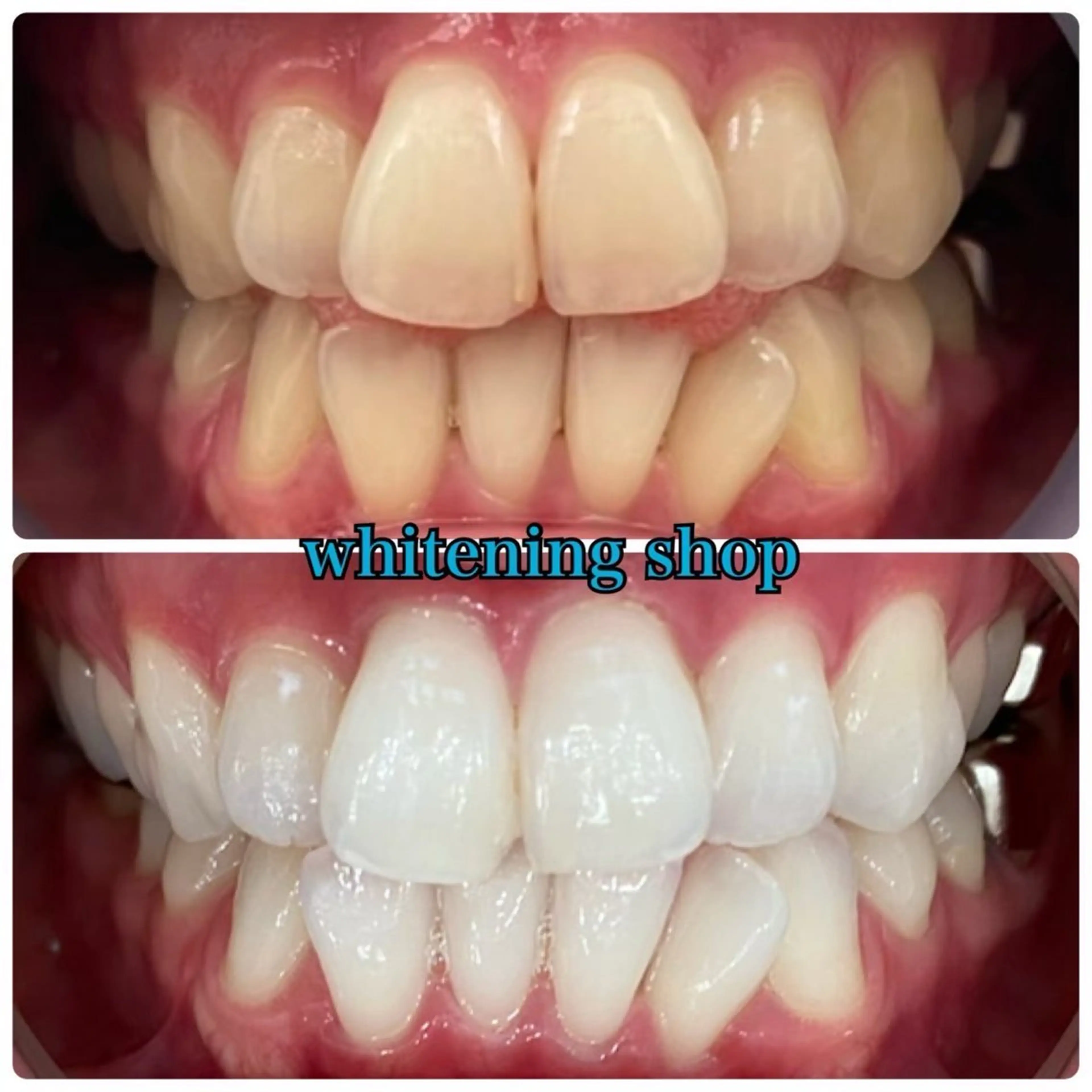 《垢抜けセット✨️》たっぷり40分照射美白セルフホワイトニング＋耳つぼジュエリーの写真