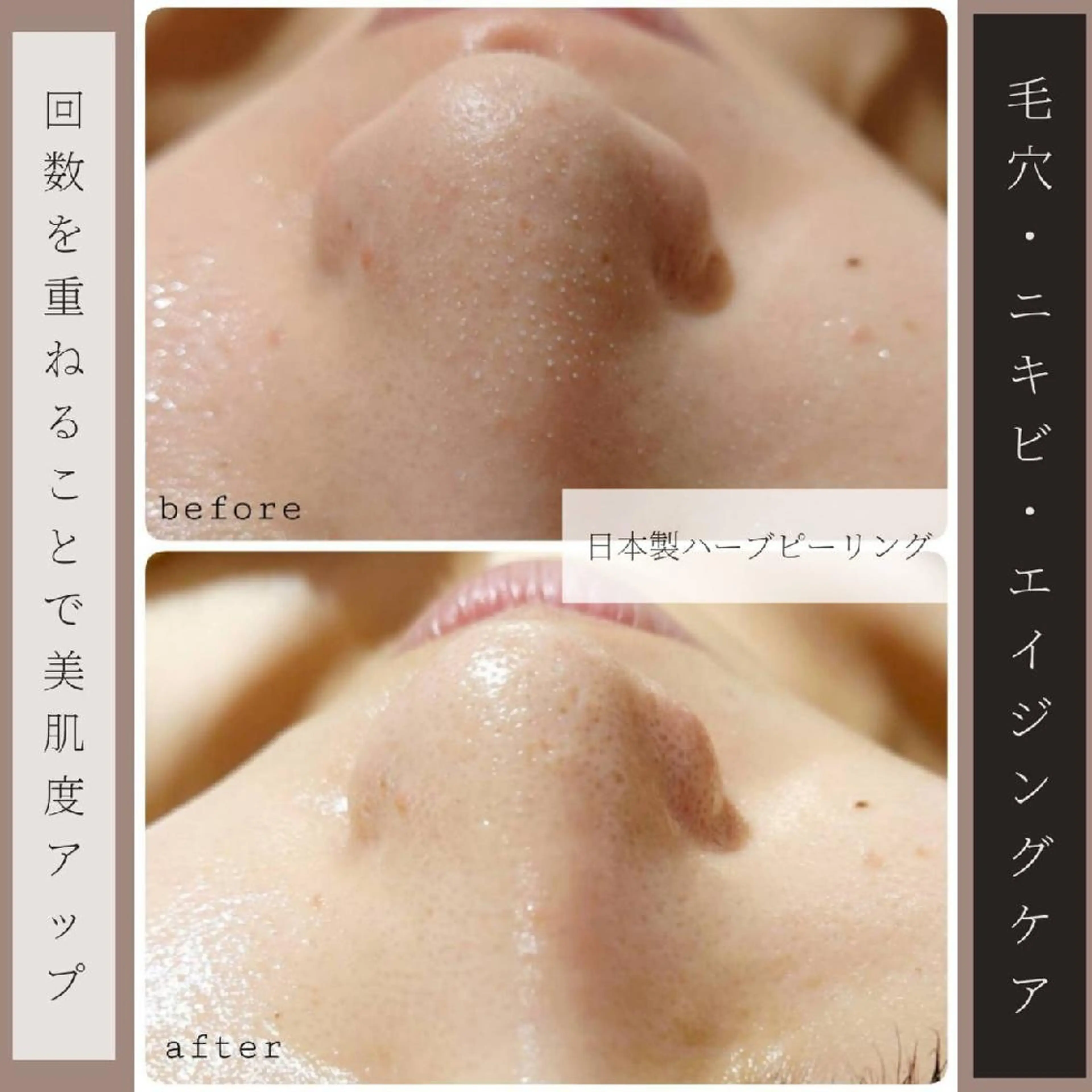 【ニキビケア/黒ずみ/ごわつき/ザラつき】毛穴洗浄+ハーブピーリングの写真