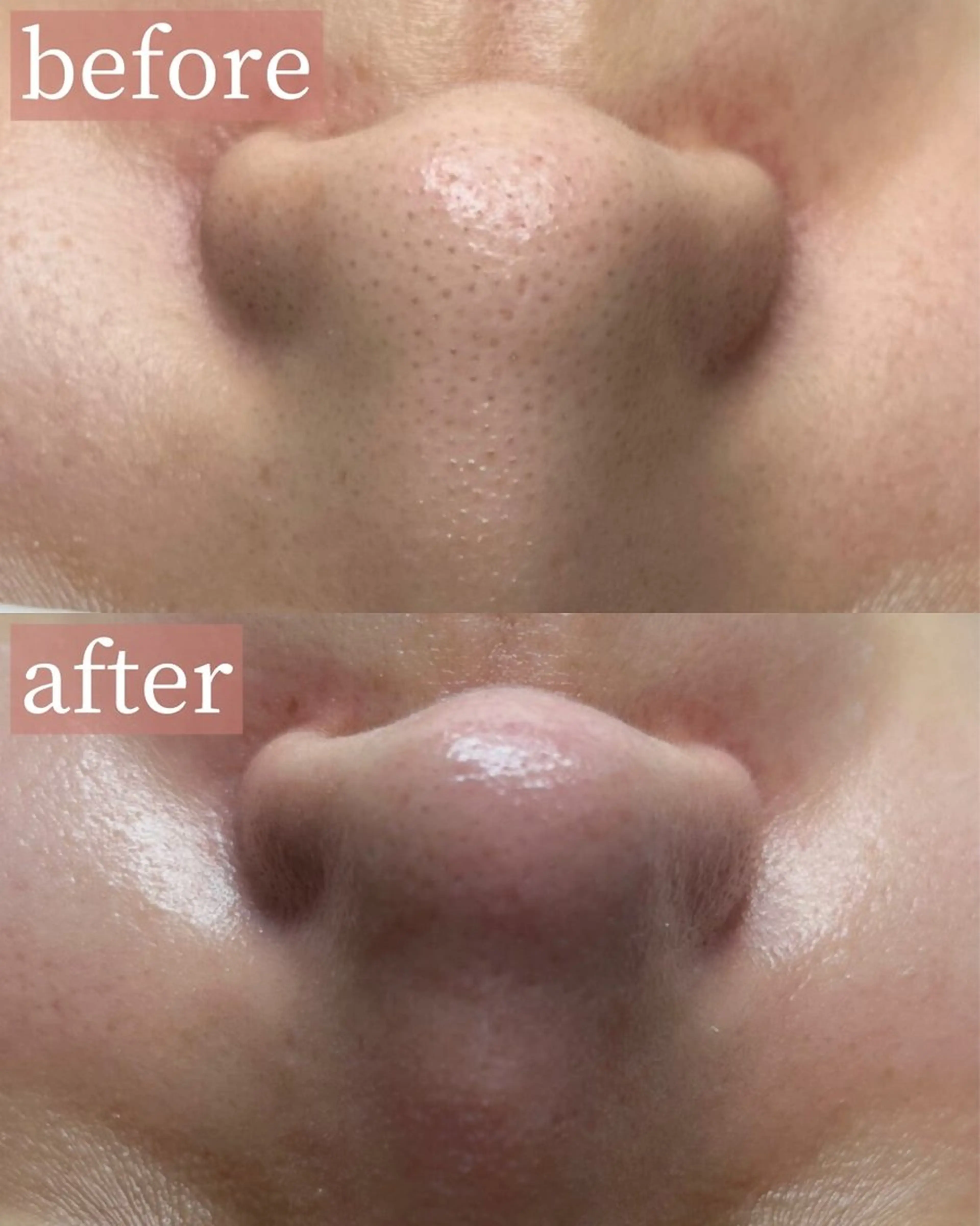 【毛穴エクストラクション】鼻の黒ずみ・ざらつき・いちご鼻に♡の写真