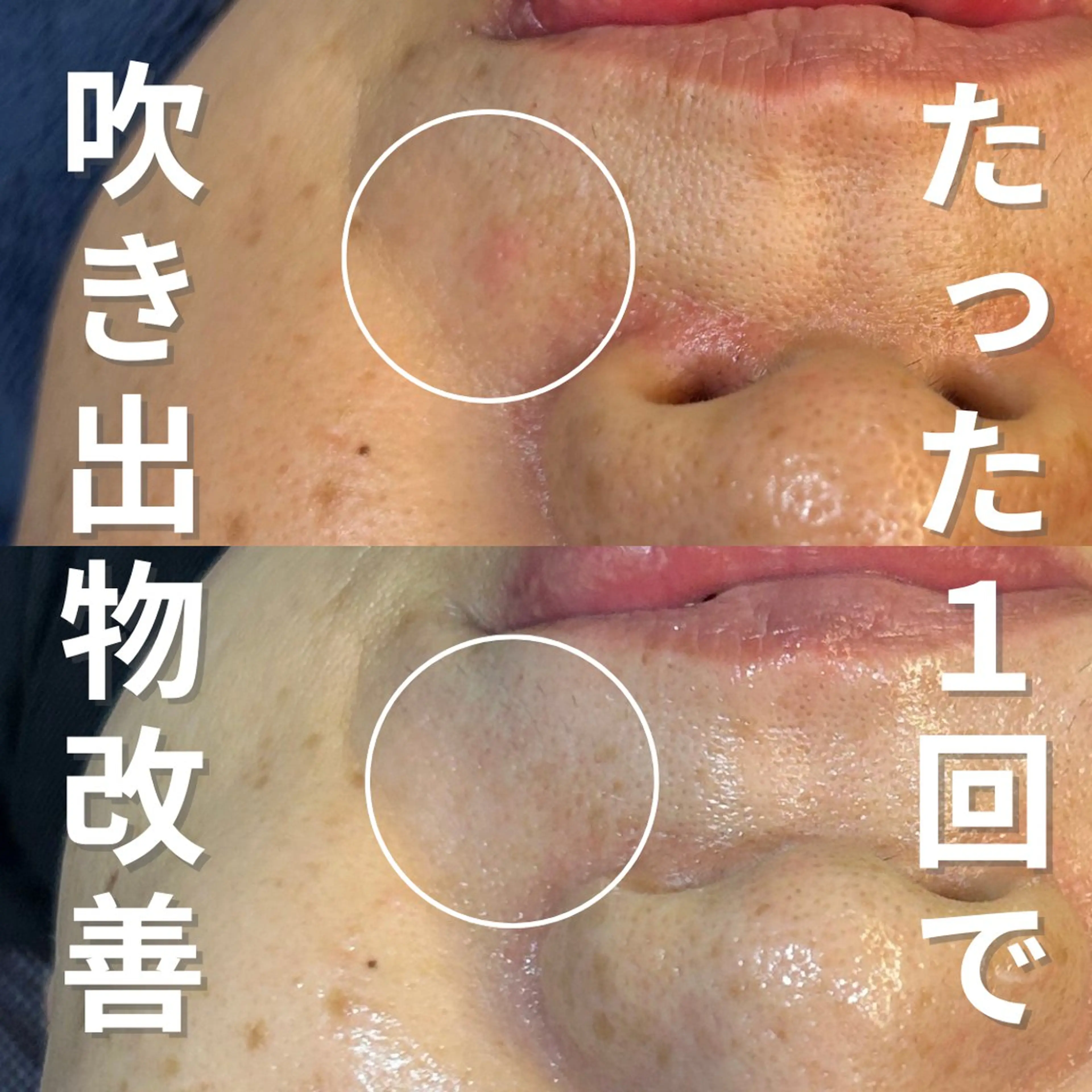 エステ ニキビ・ニキビ跡改善 leoloのエステ・リラクイメージ