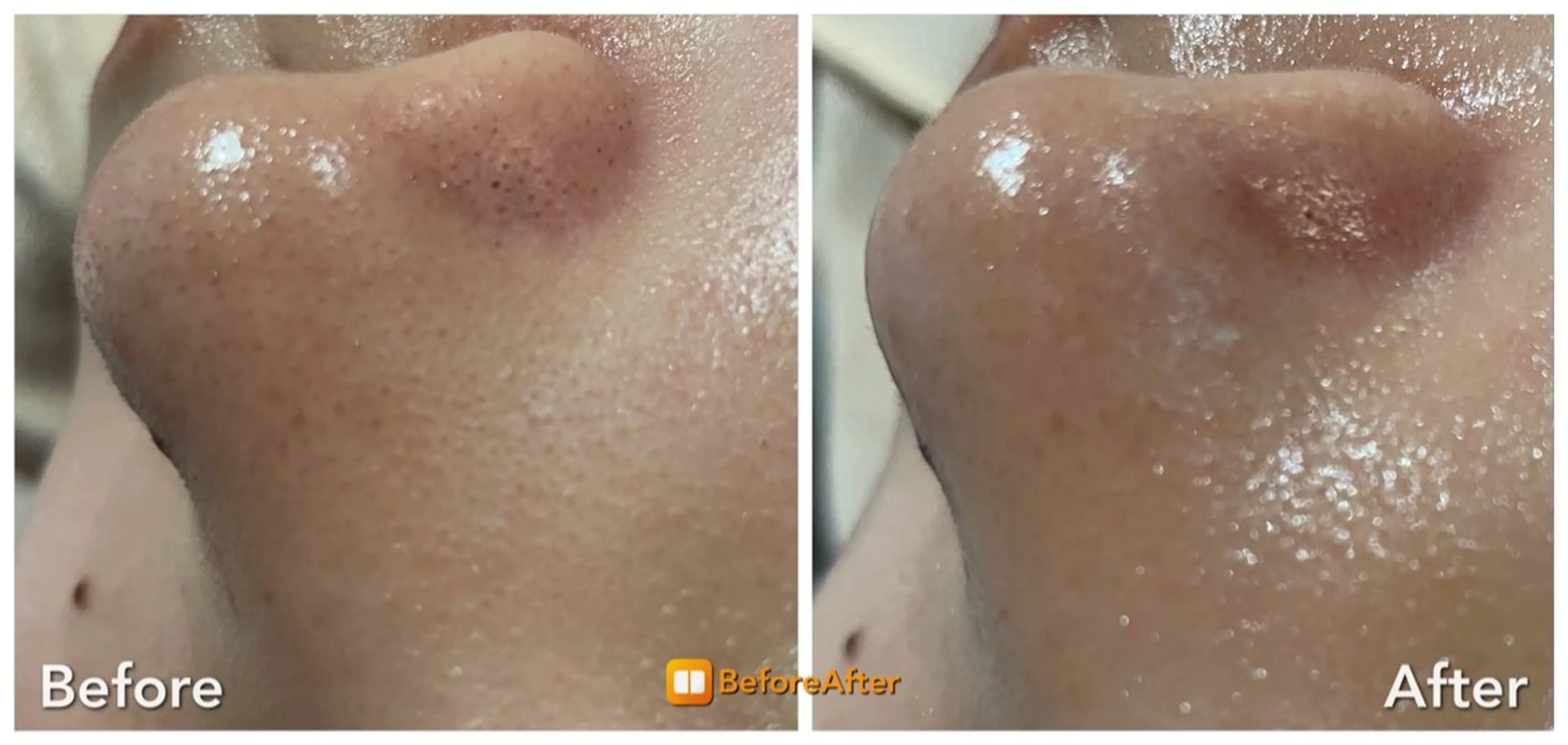 エステ Meupニキビ専門店 背中/ハーブ/肌管理のその他イメージ