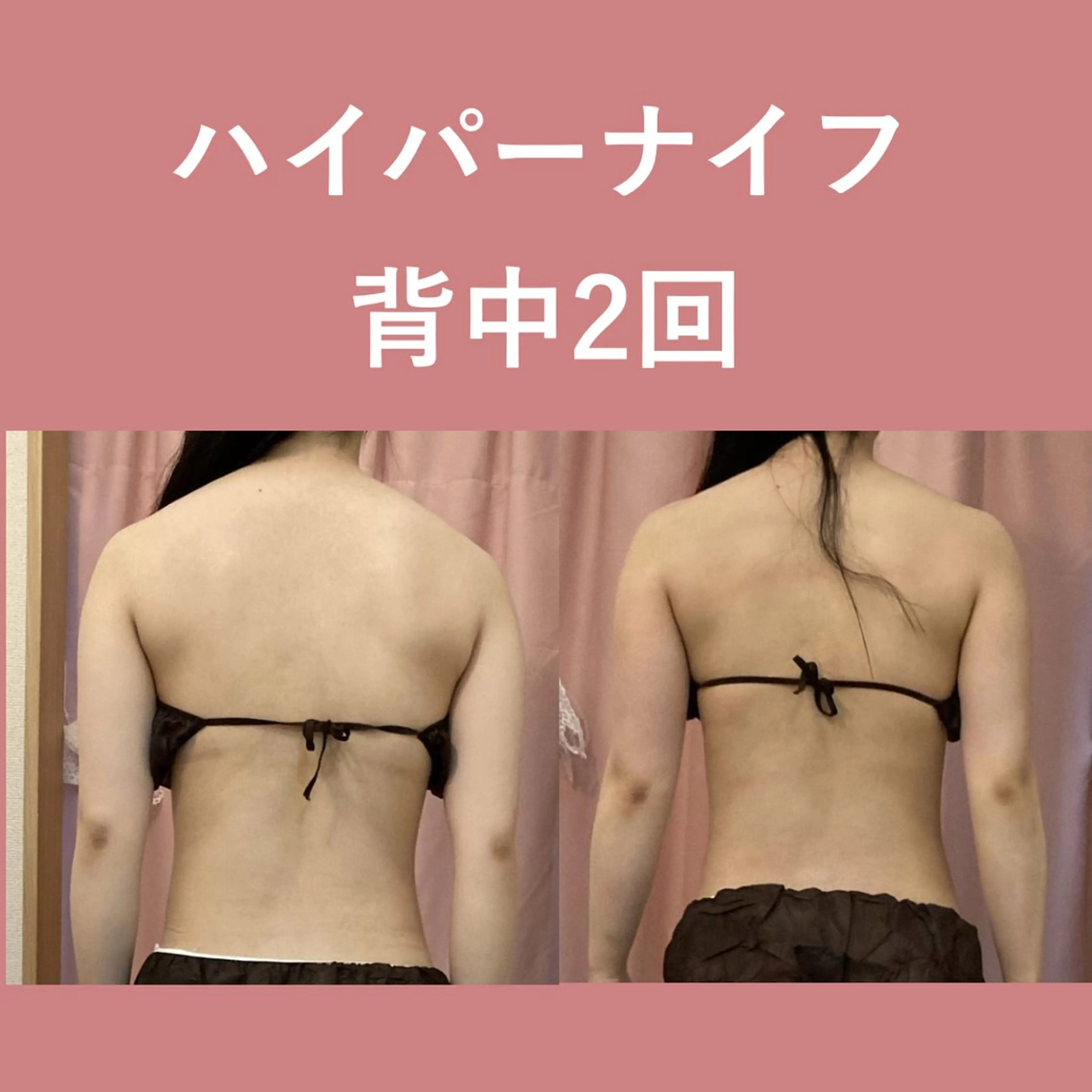 【選べる上半身or下半身45分】脂肪を燃やす！ハイパーナイフ痩身の写真