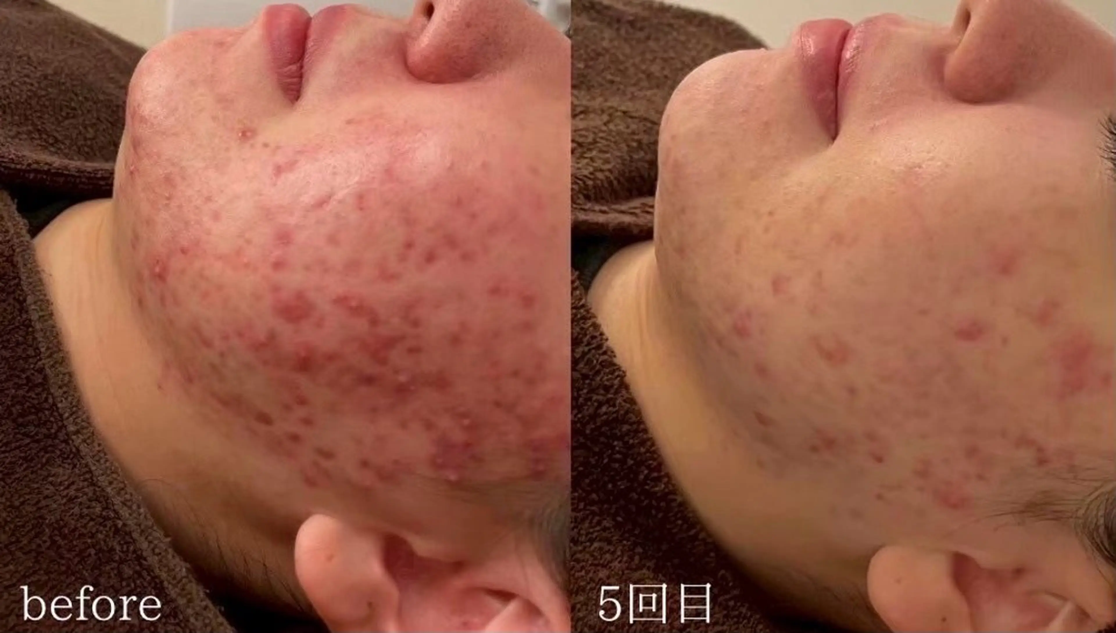 mimiBrun 肌質改善/脚浮腫みのエステ・リラクイメージ