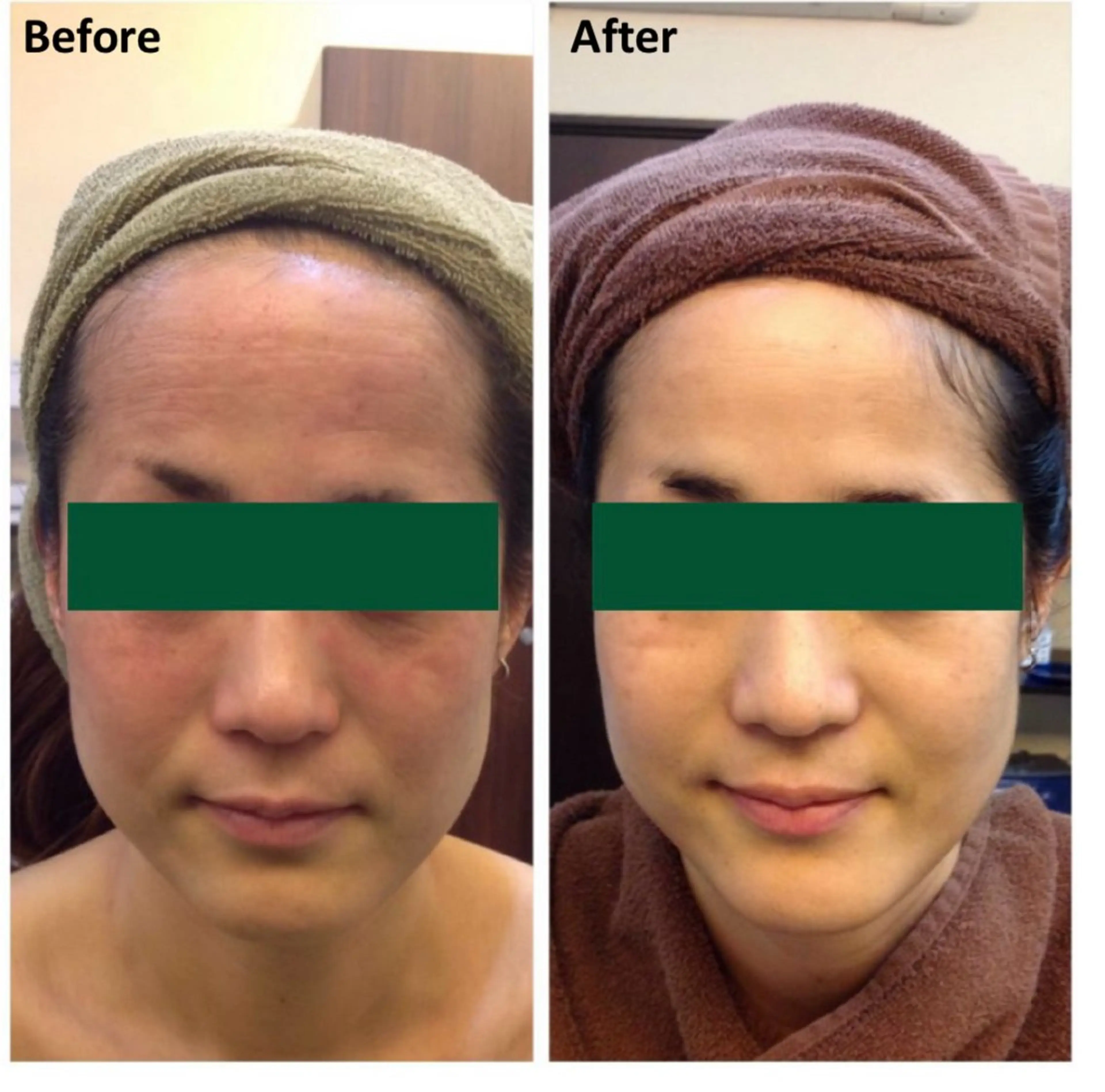 脱毛エステサロン PEAKのエステ・リラクイメージ