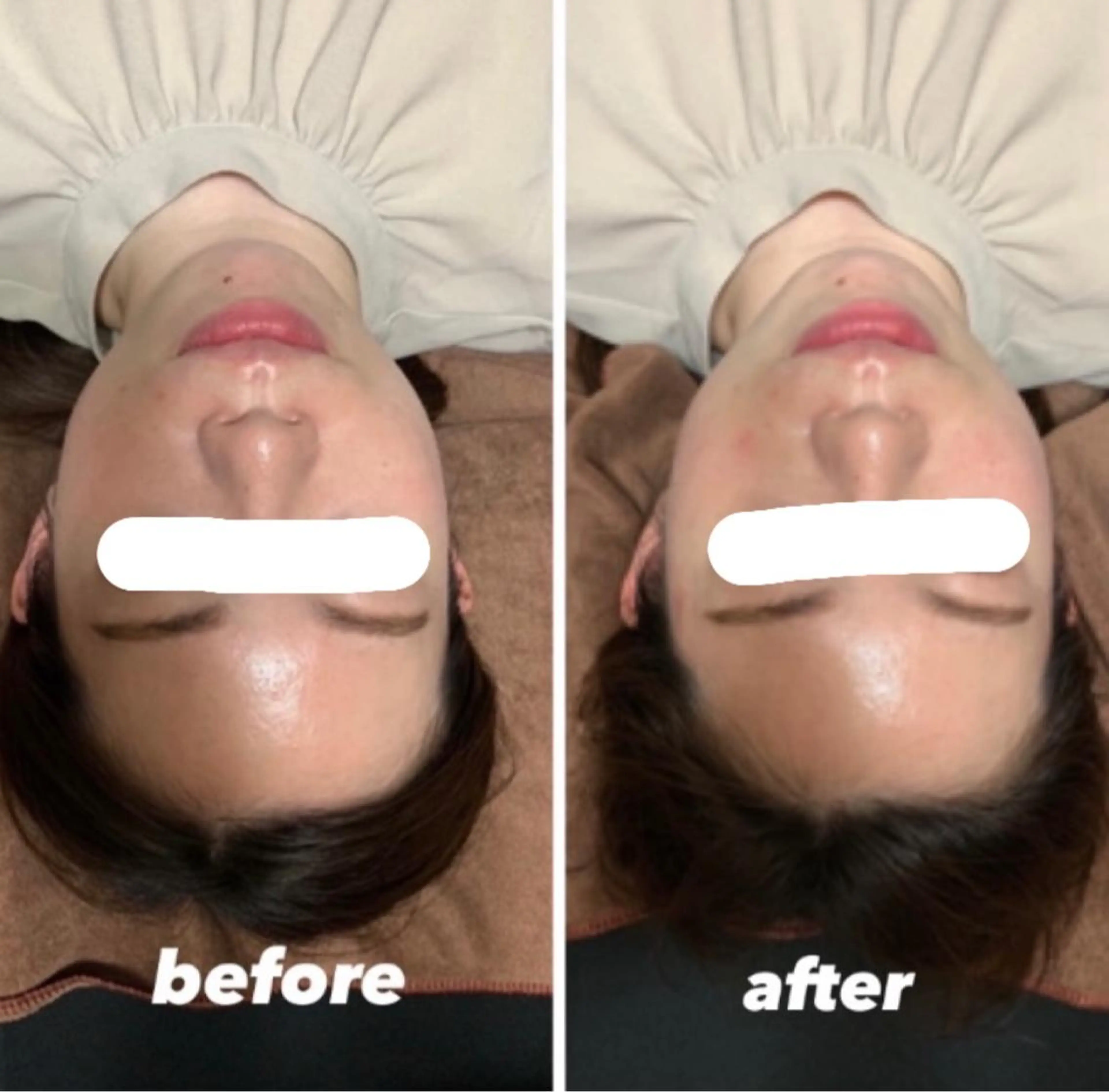 美容鍼+小顔矯正⸝⋆【前回ご来院から1ヶ月以内の方】30%OFFの写真