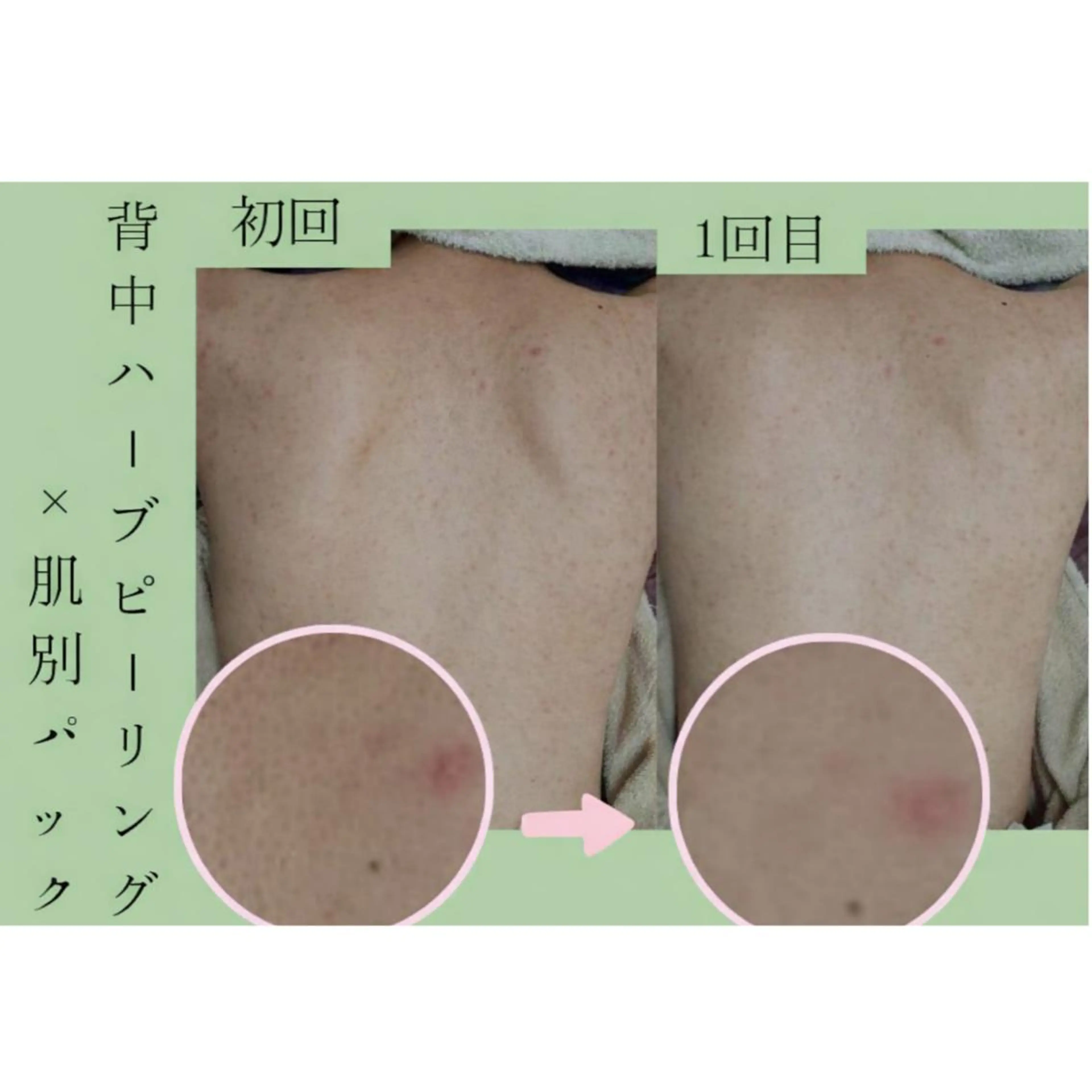 徹底背中ケア【ニキビケア×ニキビ跡など】本気でお悩みの方(4step)背面ハーブピーリング+保湿パック¥8900の写真