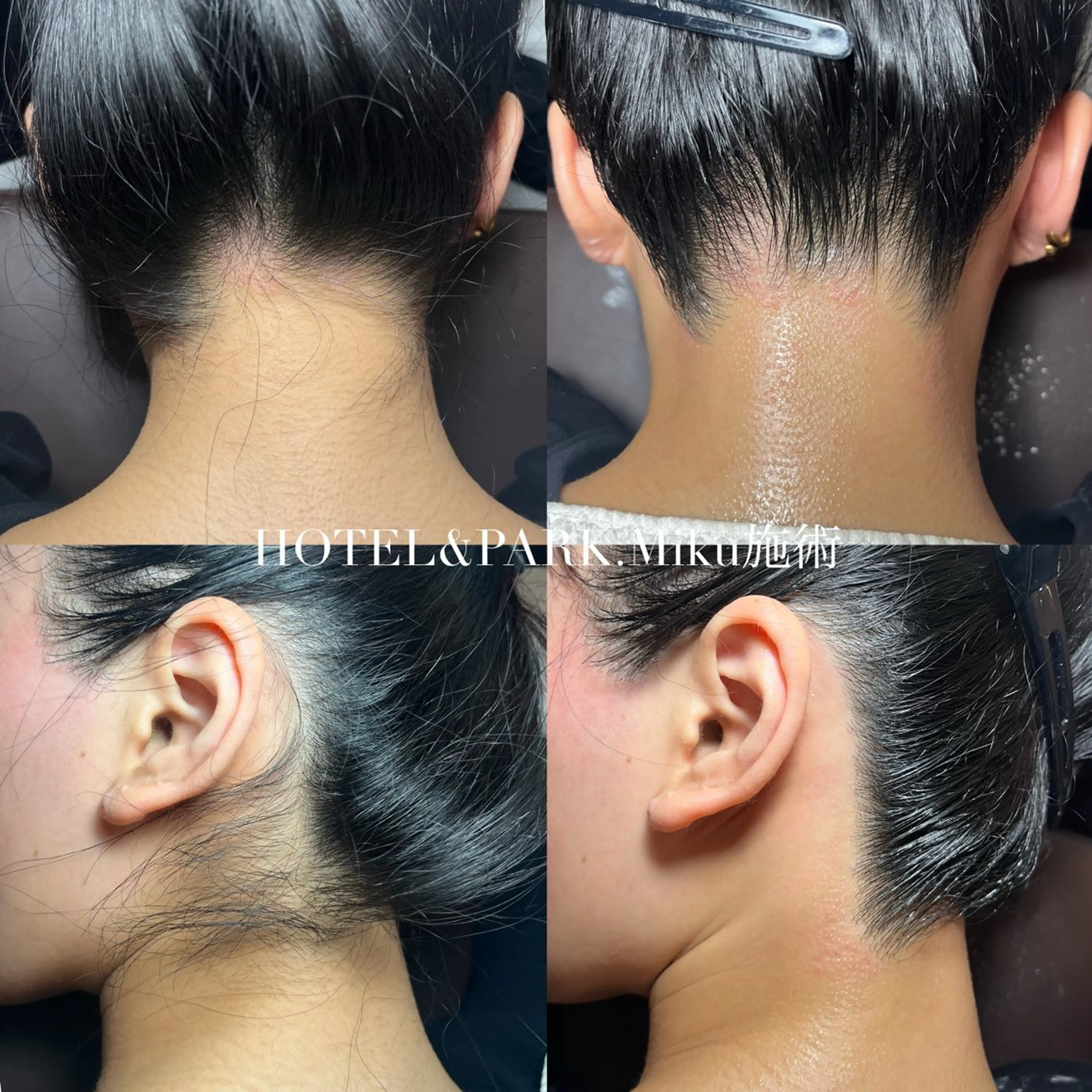 【うなじワックス脱毛】成人式・結婚式・前撮り・デート前に✨の写真