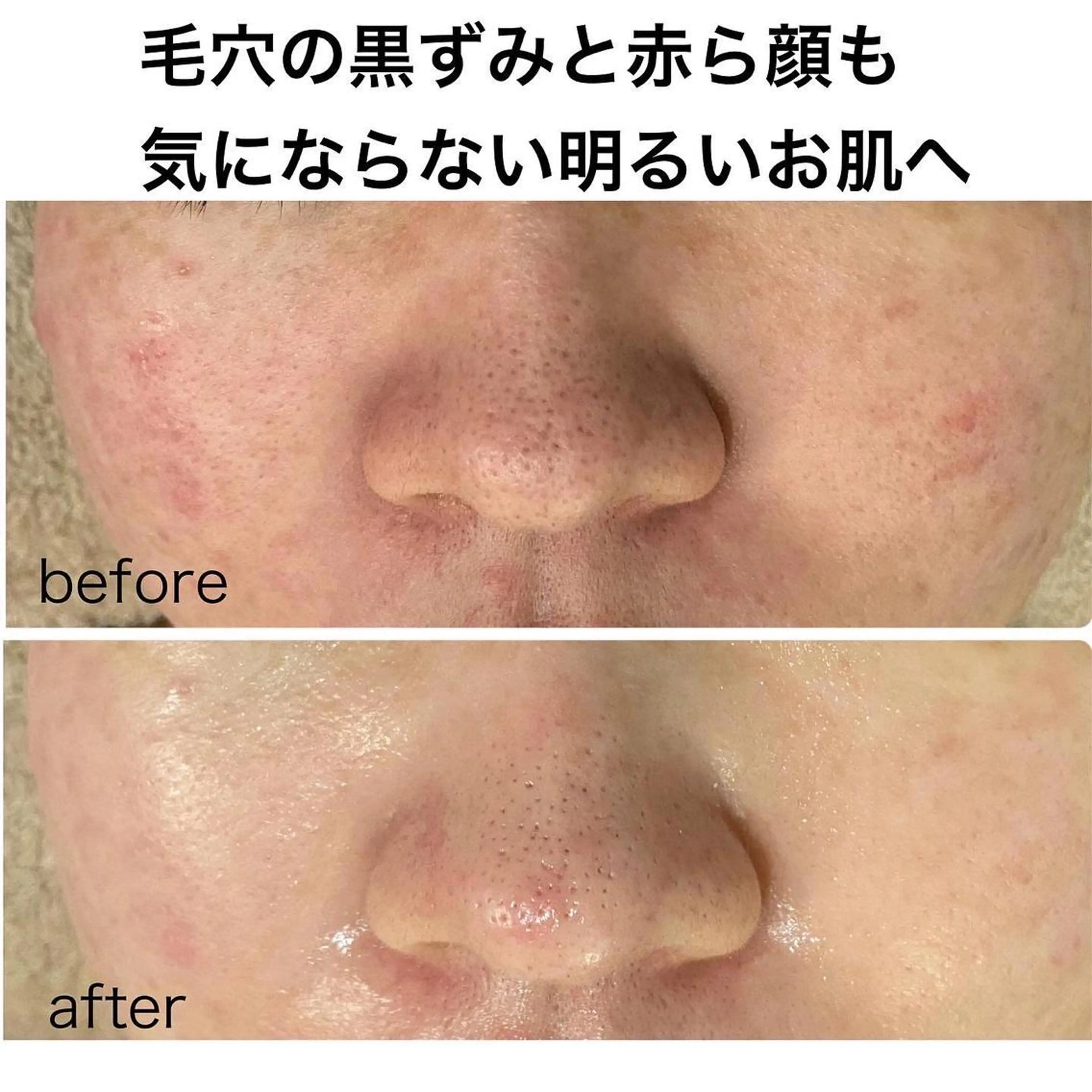 【鼻集中！】ファンデーションで隠せない毛穴のでお悩みの方/毛穴の黒ずみ/毛穴の開きの写真