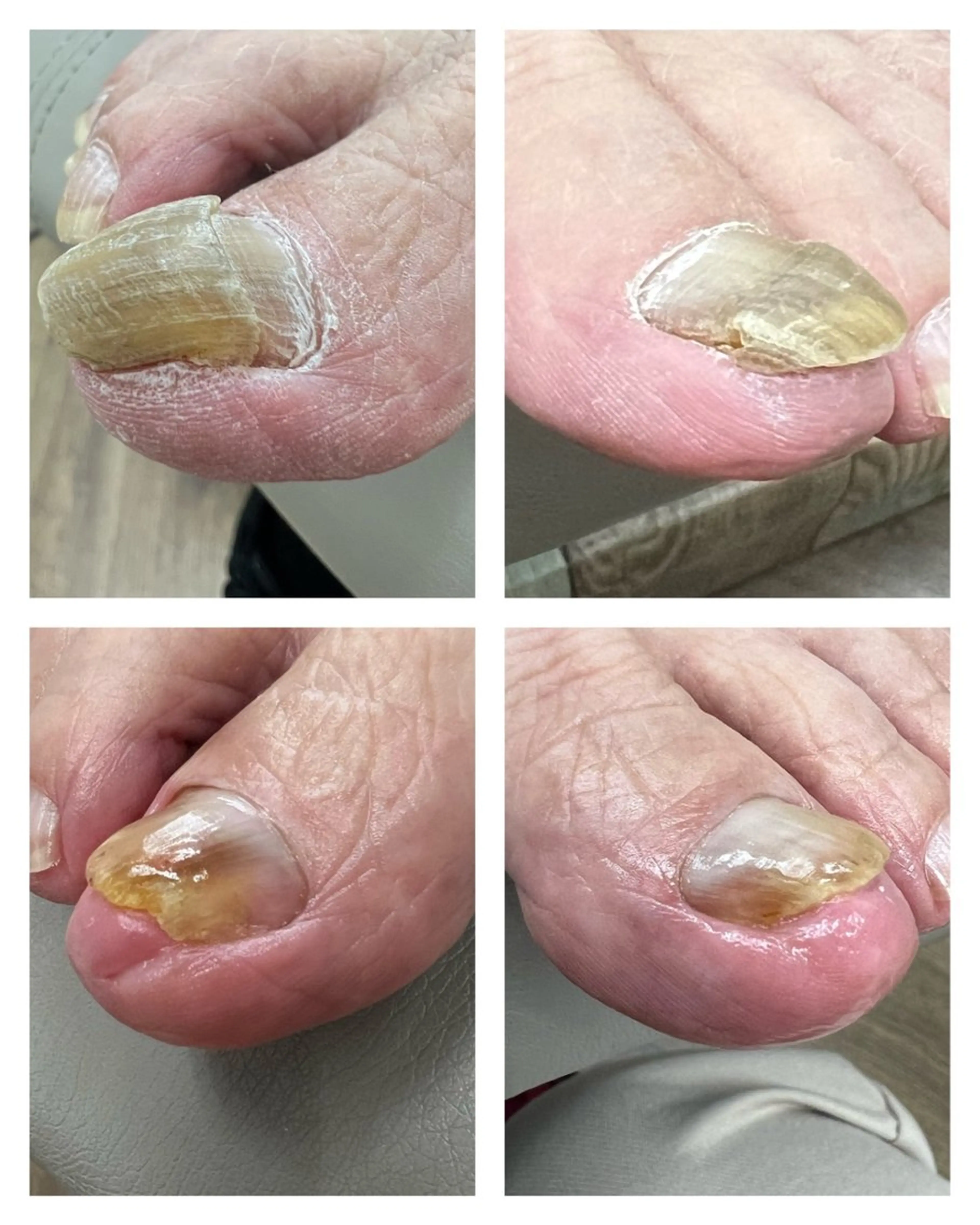 変形爪補正🦶モニター価格❣️の写真