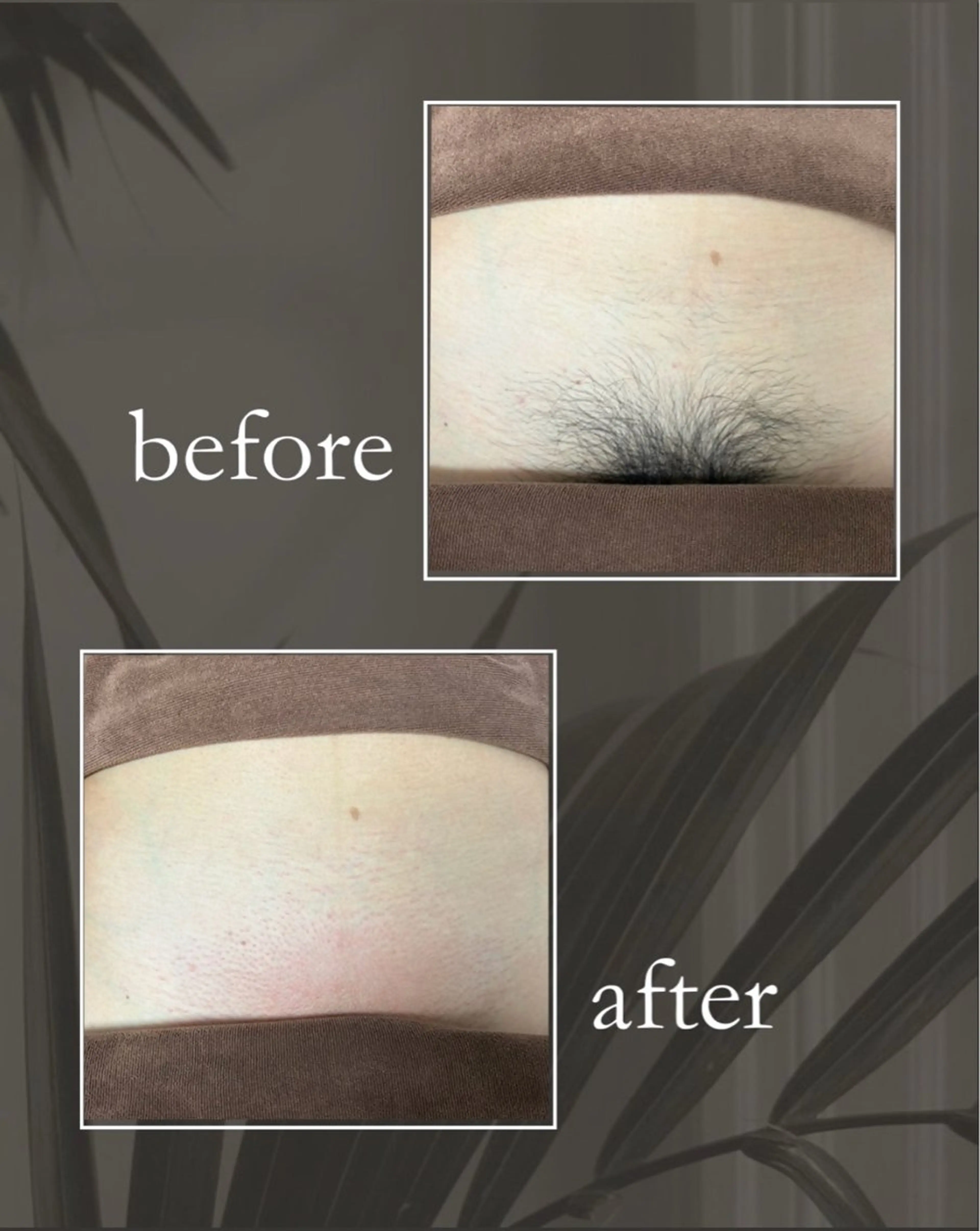 脱毛 砂原 慧子のエステ・リラクイメージ