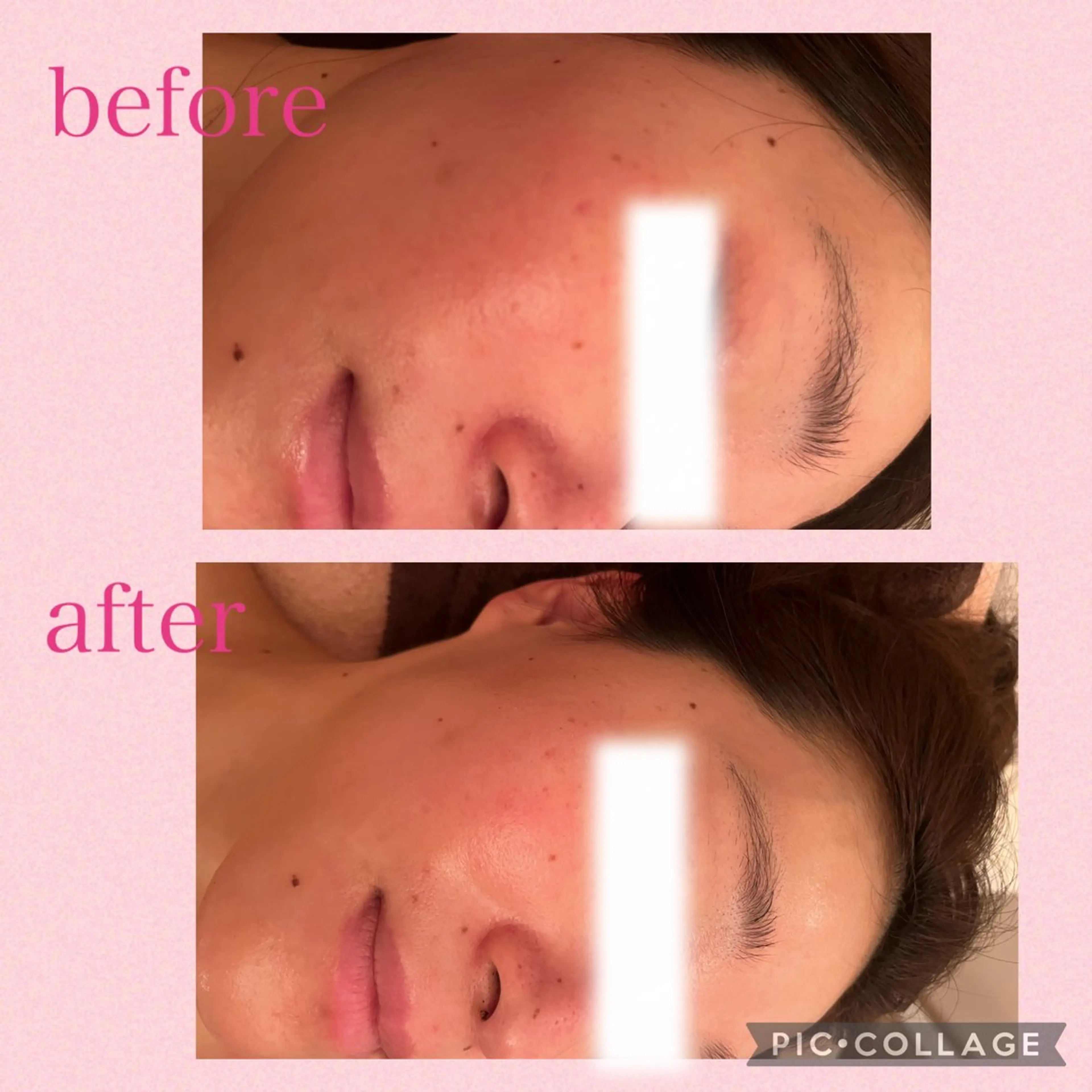 3/25迄ハーブ ピーリングBloomのエステ・リラクイメージ