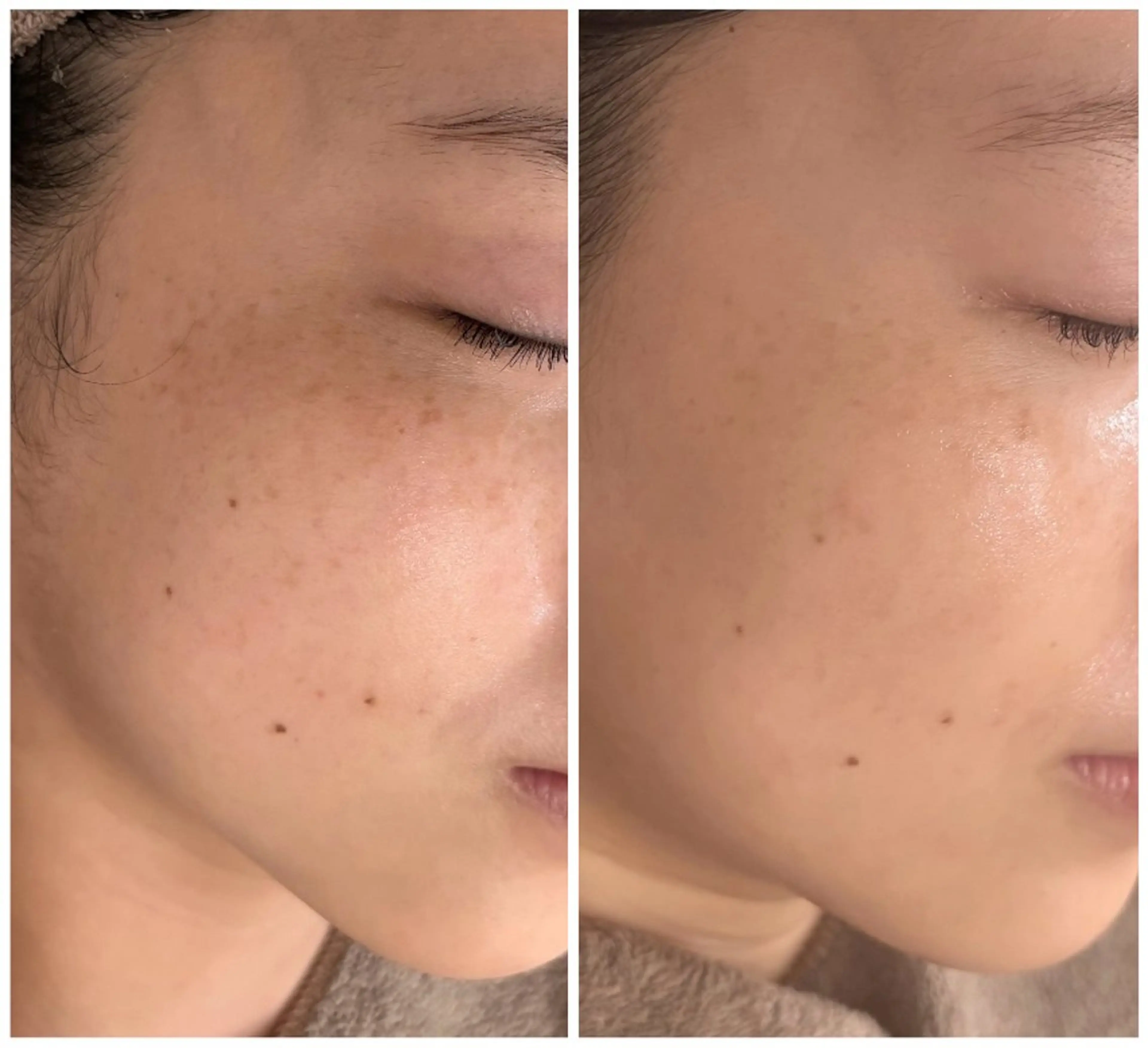 【シミ・くすみ・年齢肌に】まずは肌変化を実感！ハーブピーリングとエイジング特化美容液導入でマイナス5歳肌✨の写真