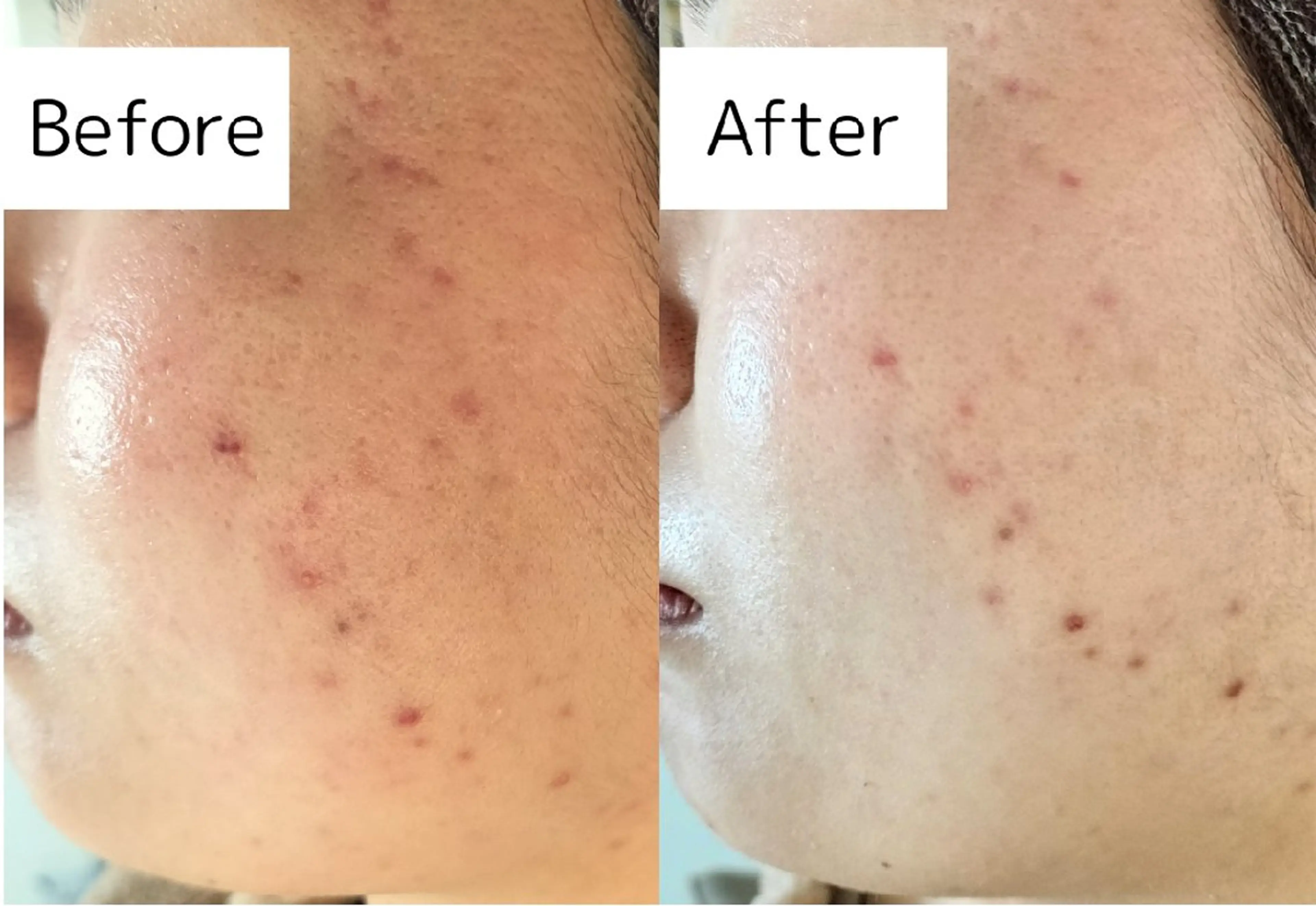 エステ 本気の肌質改善/ ハーブピーリングのエステ・リラクイメージ