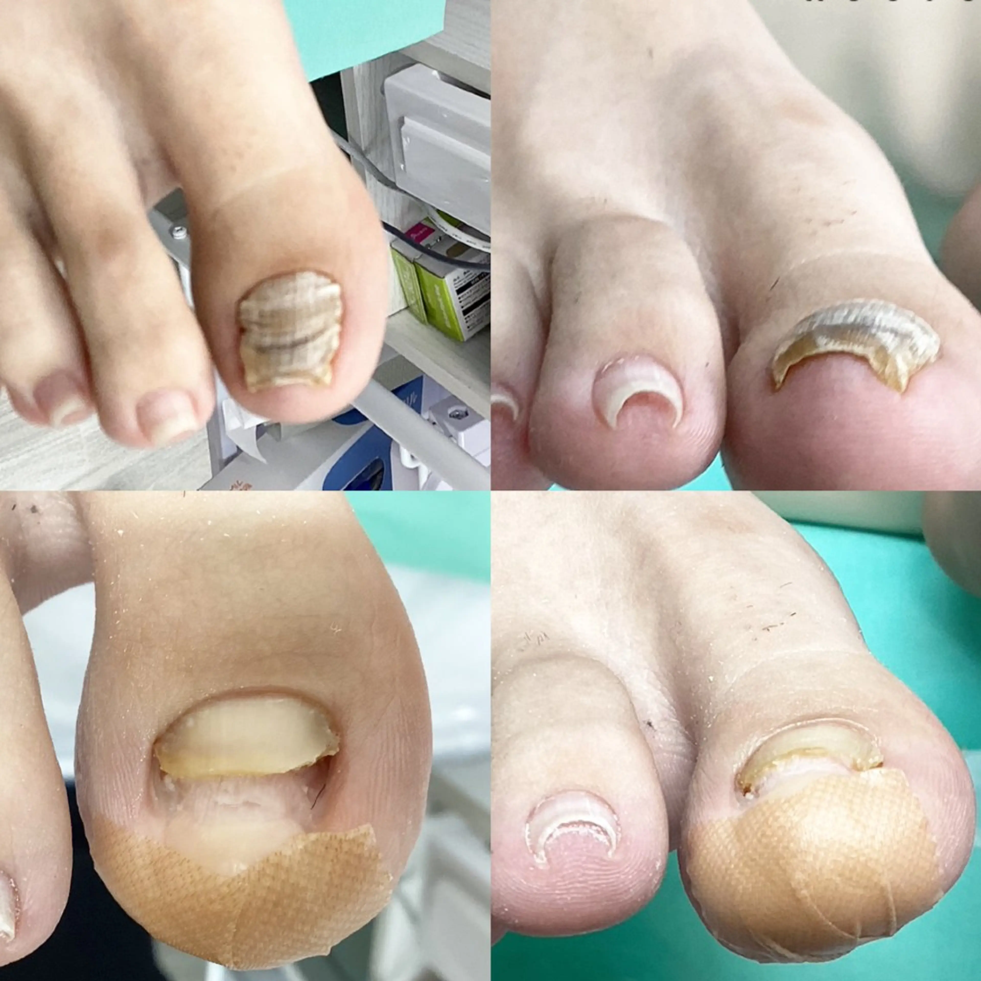 巻き爪補正店 大阪なんば店のネイルデザイン