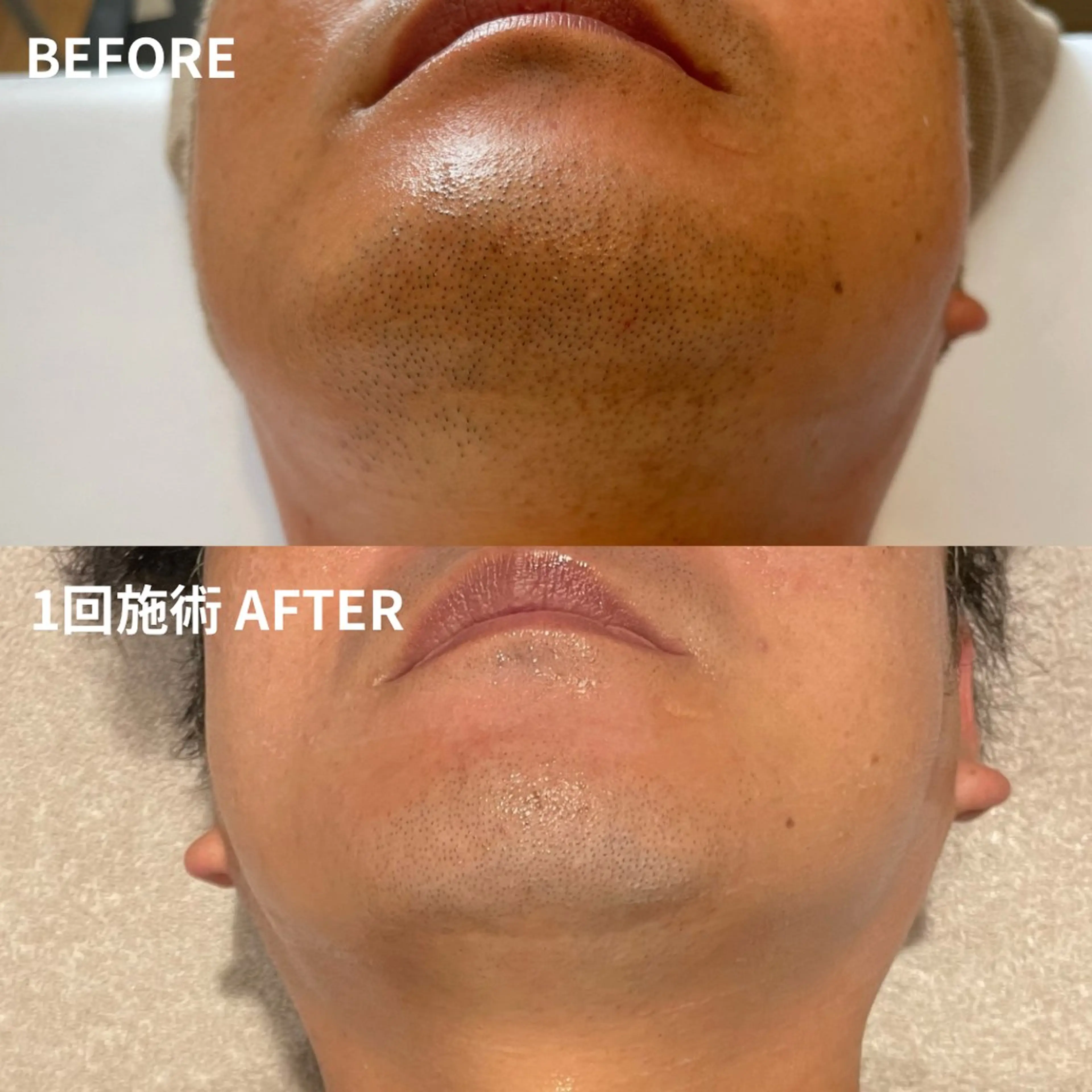 メンズ 脱毛 Lassy Yuriの眉毛・アイブロウイメージ