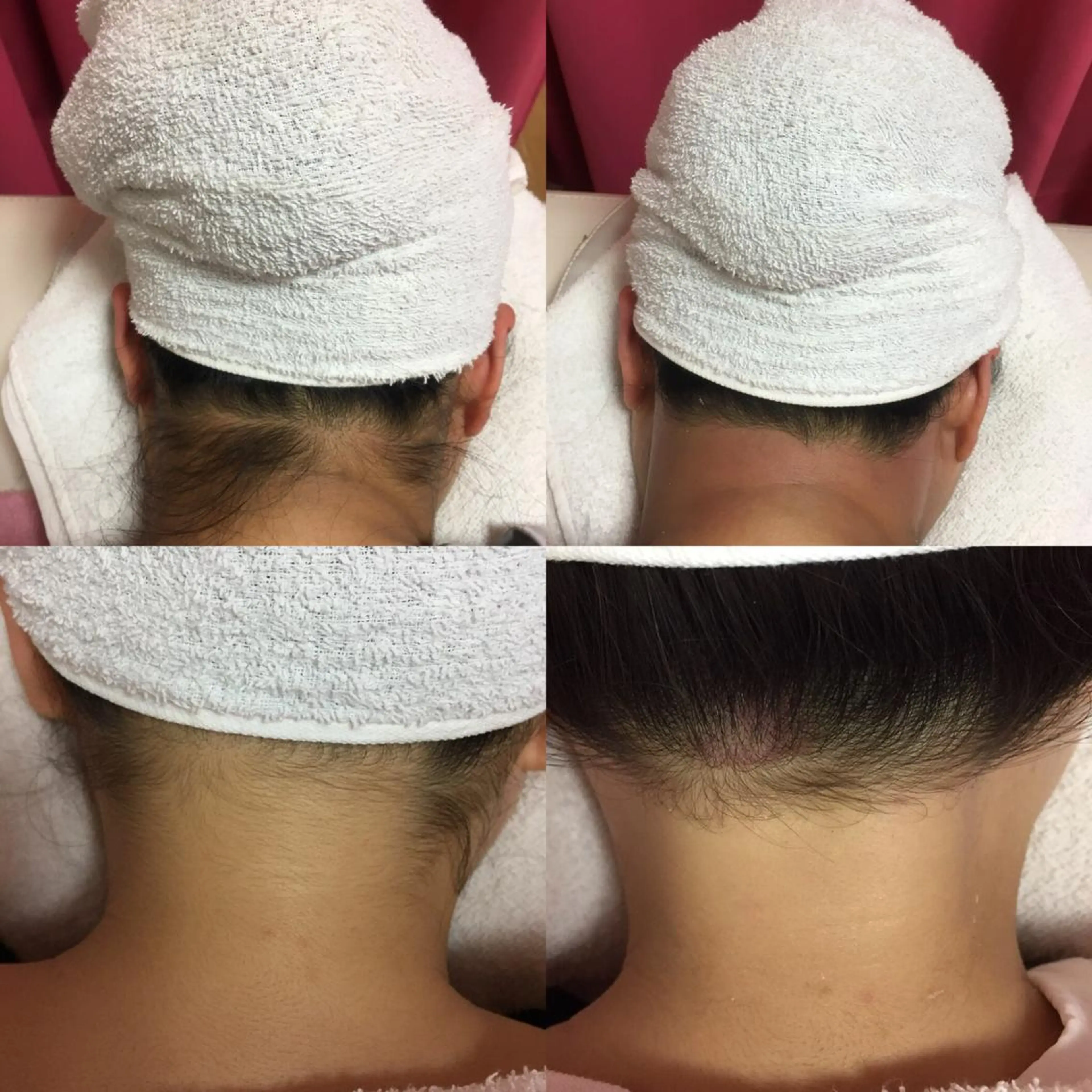 女性限定！本場ブラジリアンワックス　うなじの写真