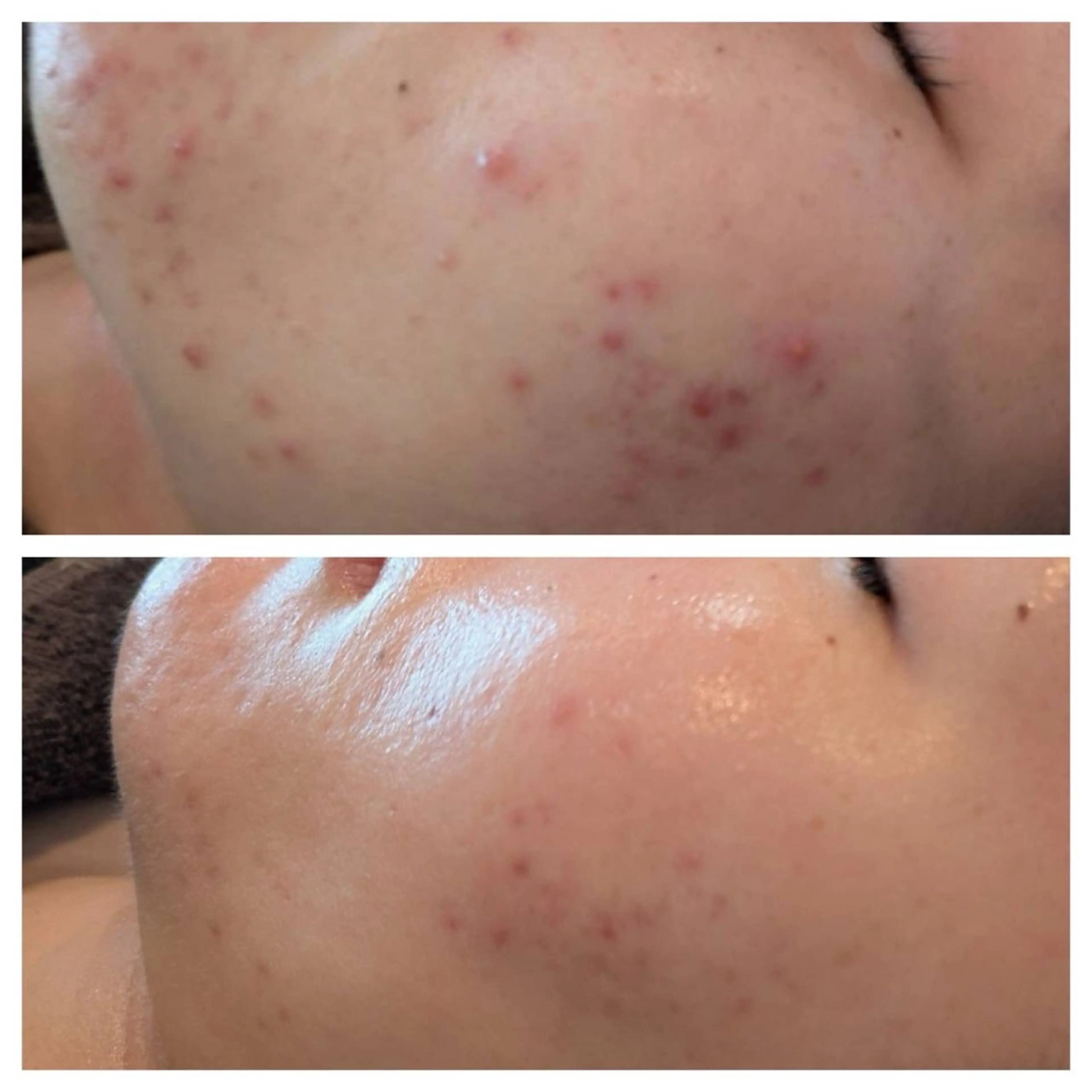 【年齢、本気改善】未来まで見据えたREVIハーブピーリングの写真