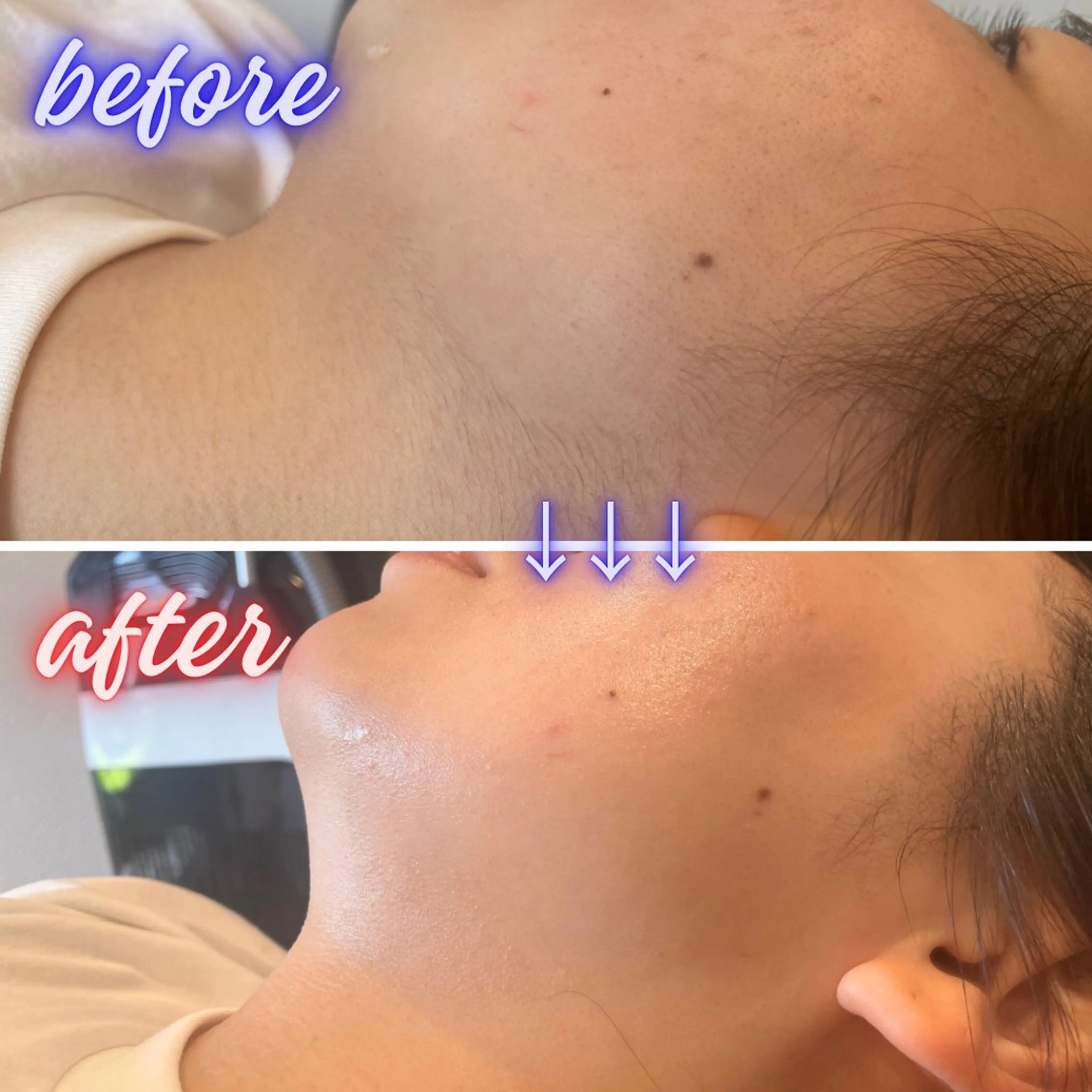 脱毛 KAUI +🌺 Maiのエステ・リラクイメージ