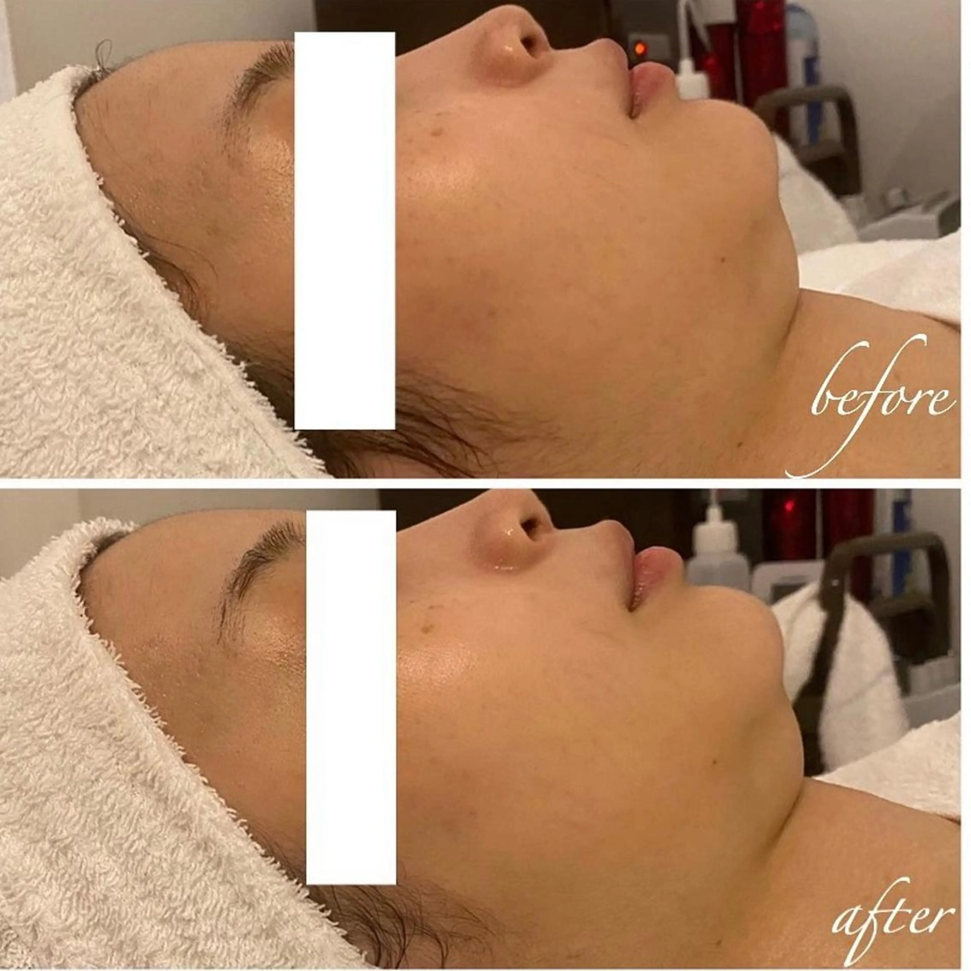 韓国/ピーリング 毛穴洗浄/POLAのエステ・リラクイメージ