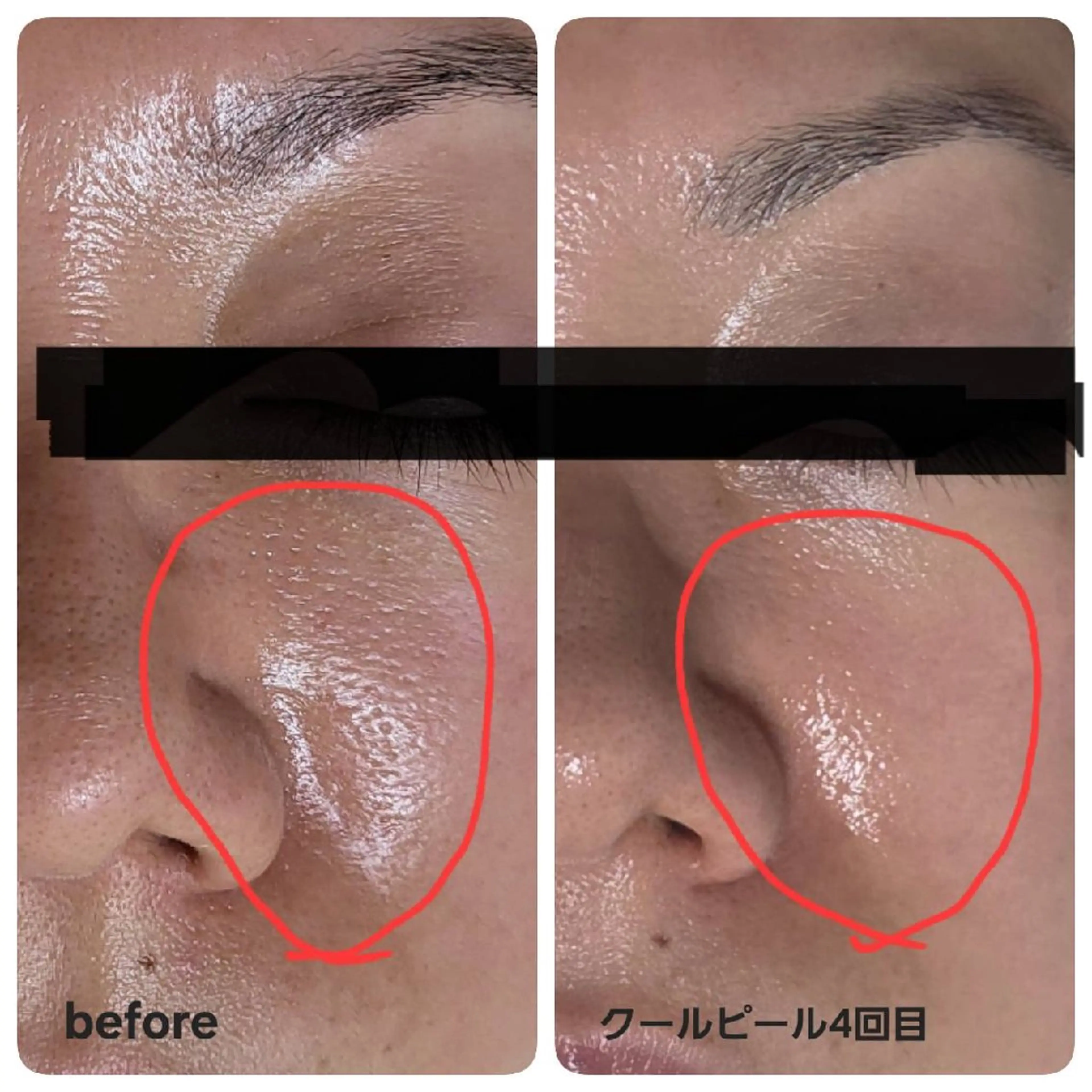 毛穴キュッ✨&トーンUPしたい方へ🔜ダウンタイムなしのピーリング+レチノール+ビタミンCイオン導入の写真