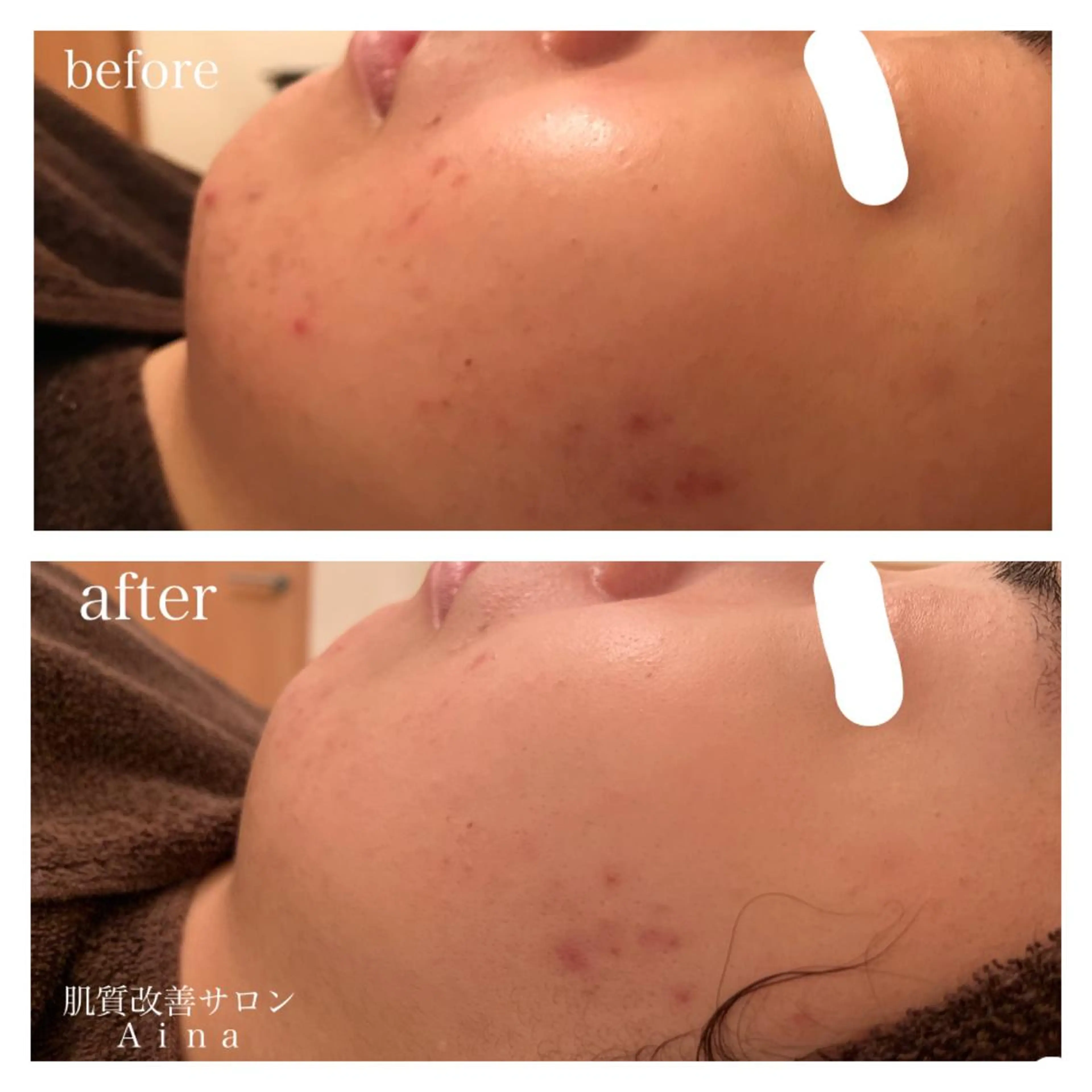 ロング ヘアアレンジ キッズ ネイル マツエク・マツパ エステ リラク ニキビ跡専門サロン Ａｉｎａのエステ・リラクイメージ