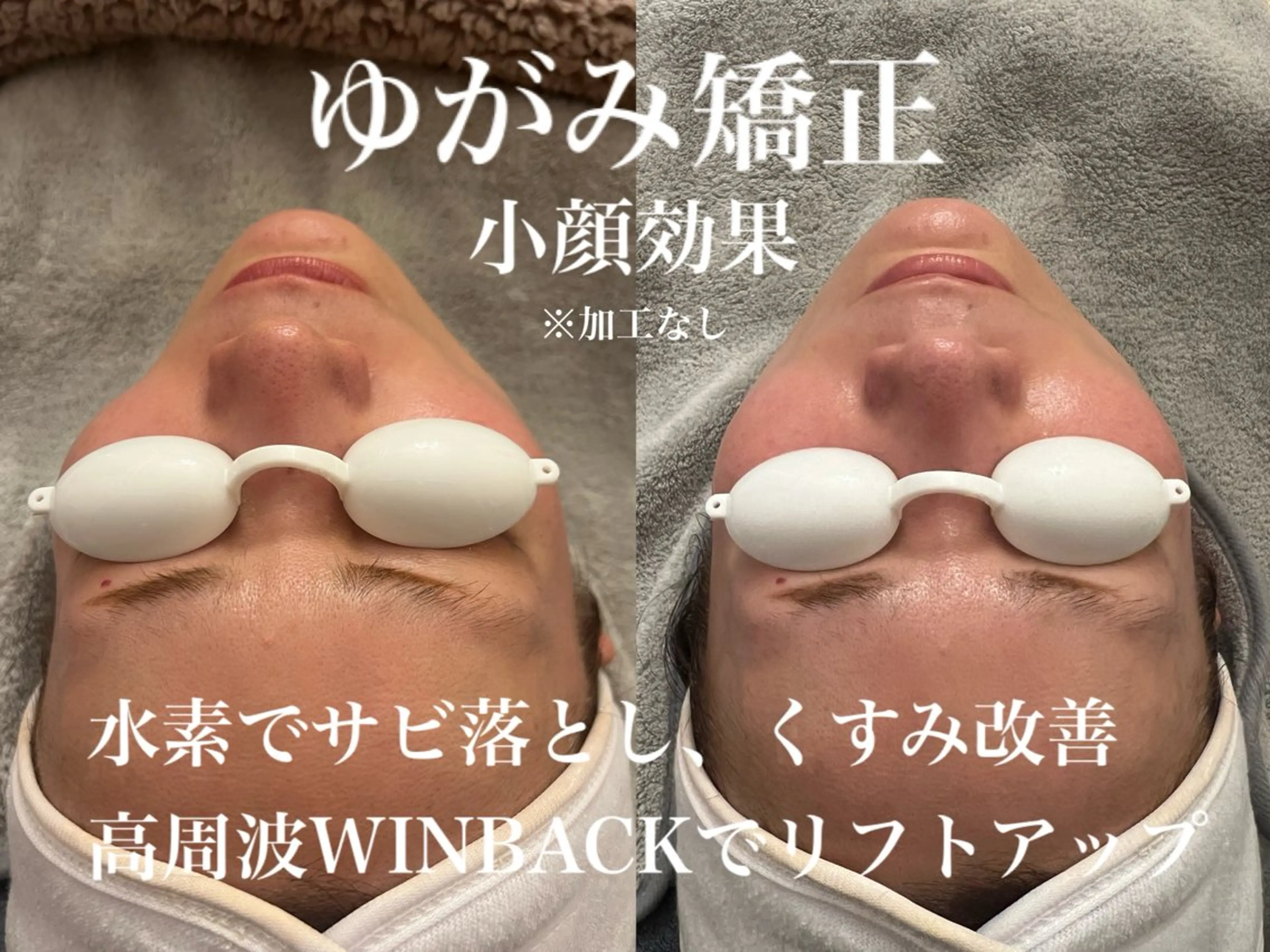 【全営業時間&単発メニュー】秋の毛穴シミ撲滅！美白美肌へ！水素高周波のWアプローチ！フェイシャルエステ体験の写真