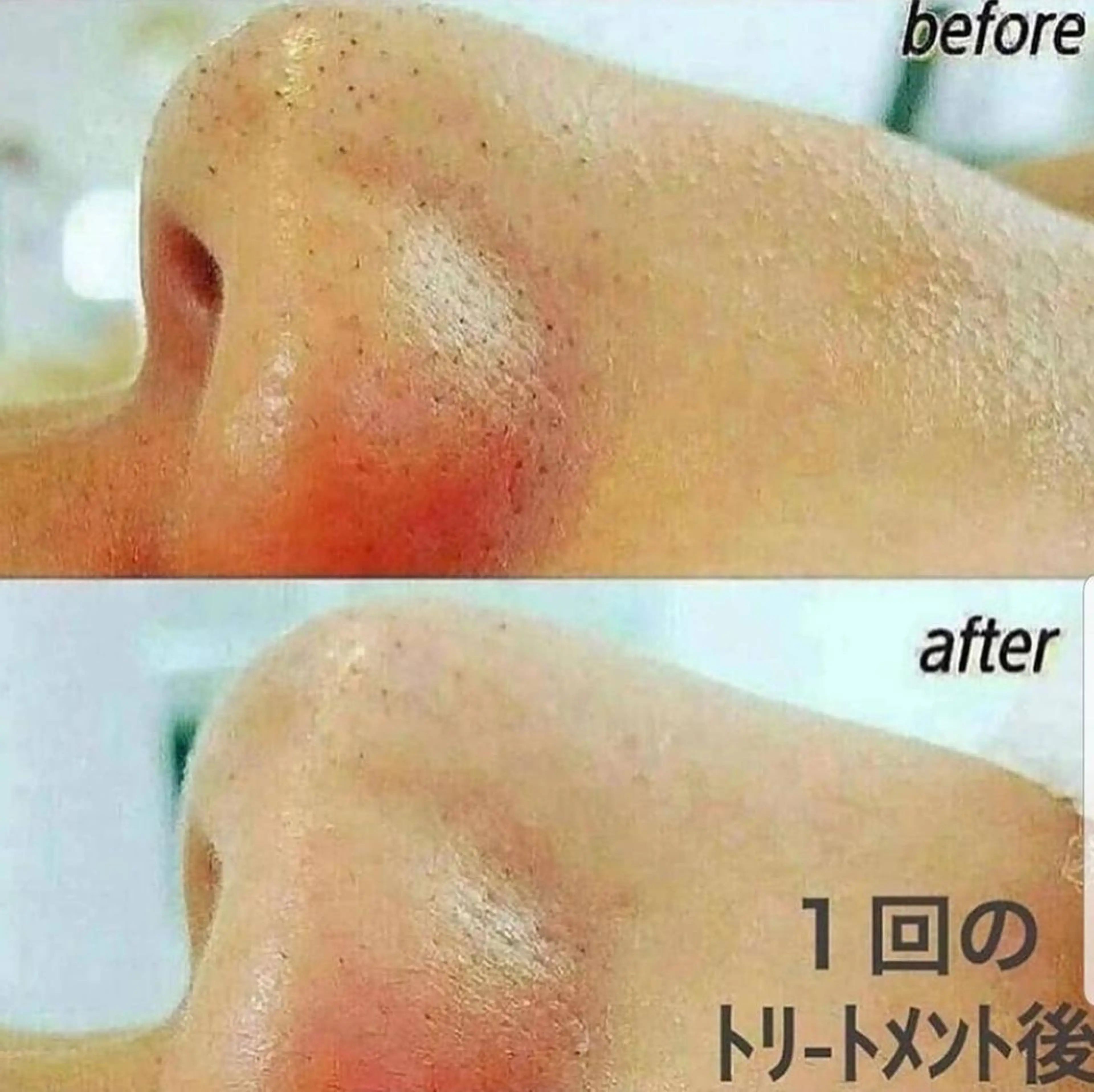 ニキビケア◇ニキビ跡 レゾン京橋店 八崎のエステ・リラクイメージ