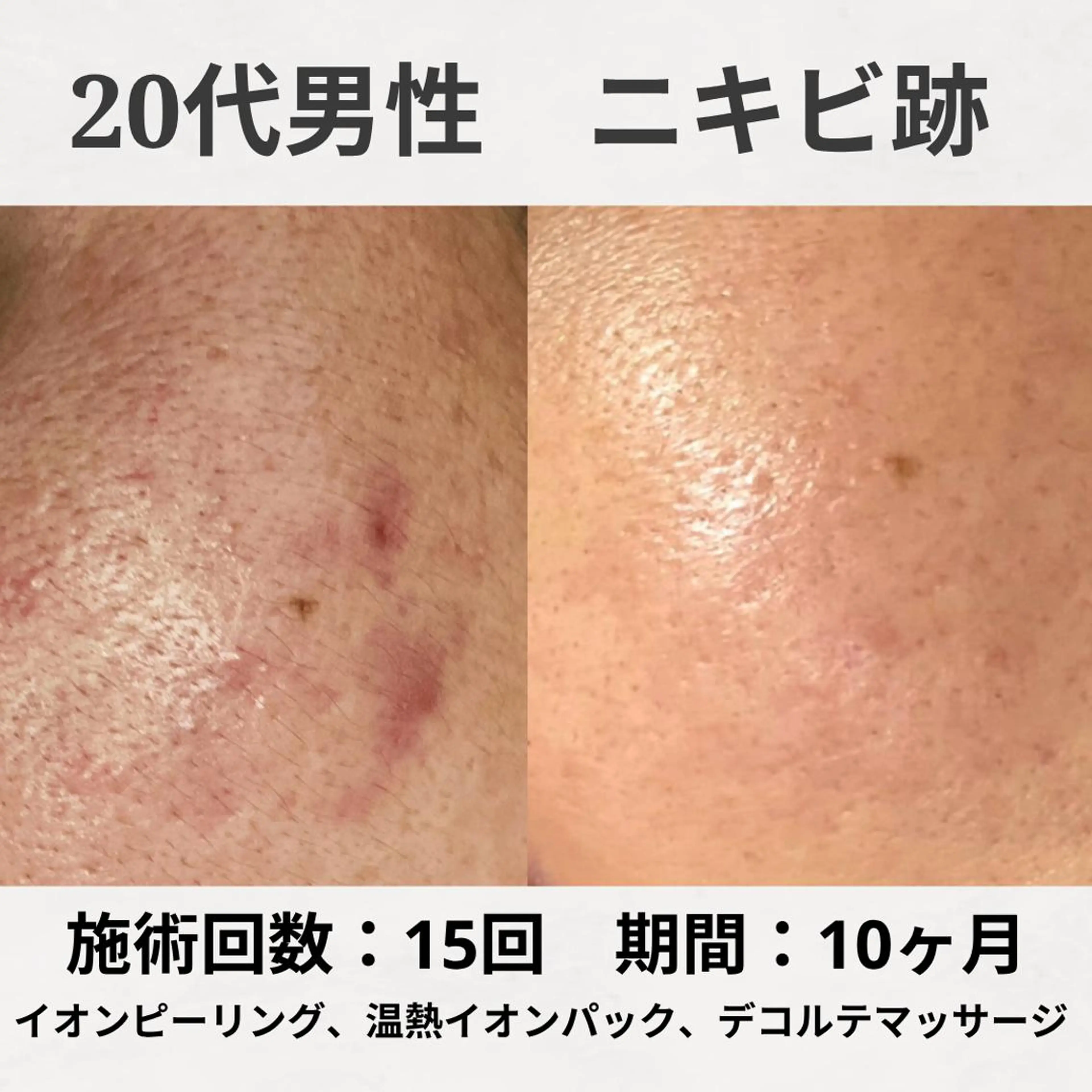 エステ リラク ニキビ跡改善専門🔥 医療にはできない改善のエステ・リラクイメージ