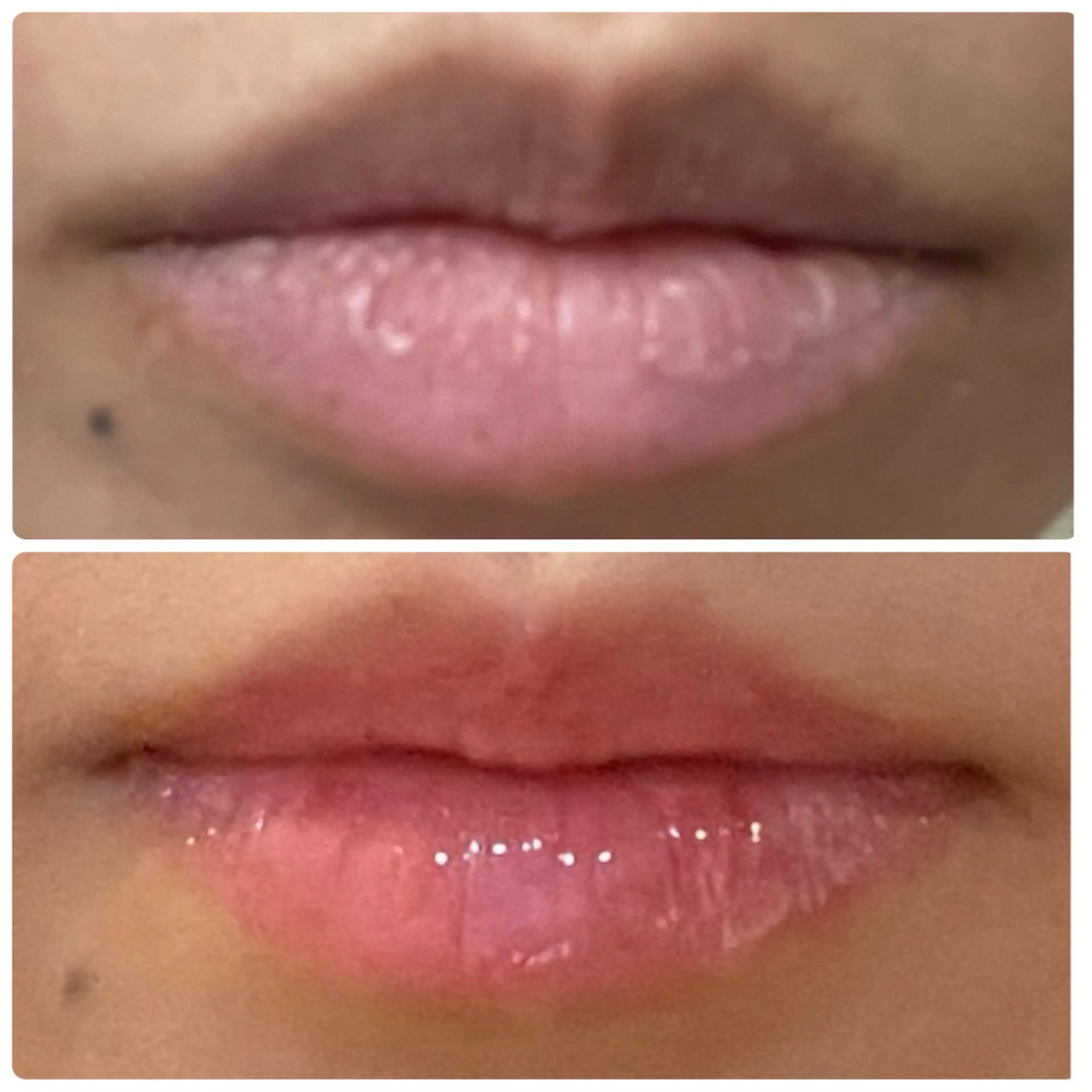 【ローマピンク🩷無料相談30分】バストトップ・唇の黒ずみVIOを赤ちゃんピンクへの写真