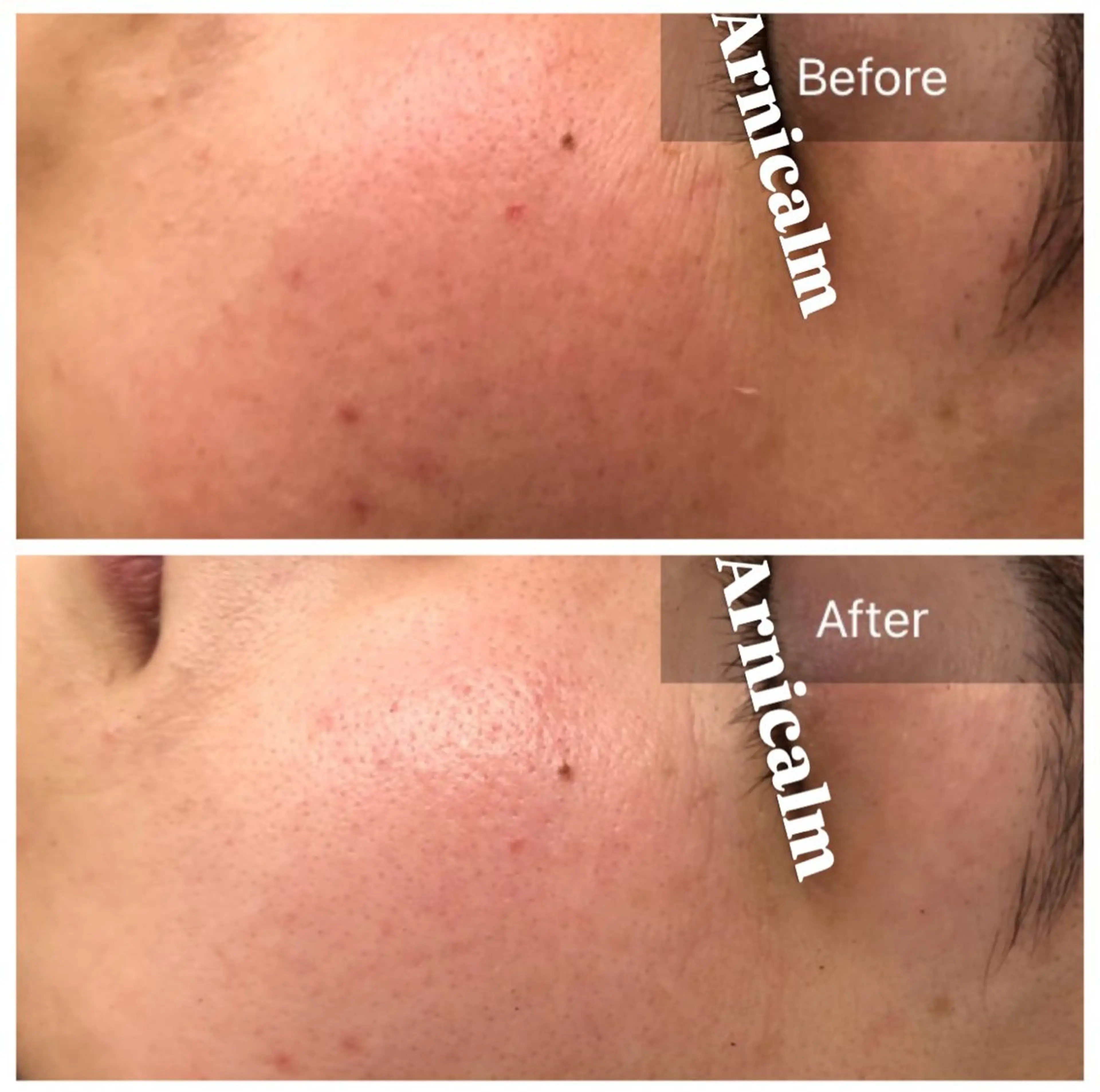 ハーブピーリング 肌再生ピーリング/のエステ・リラクイメージ