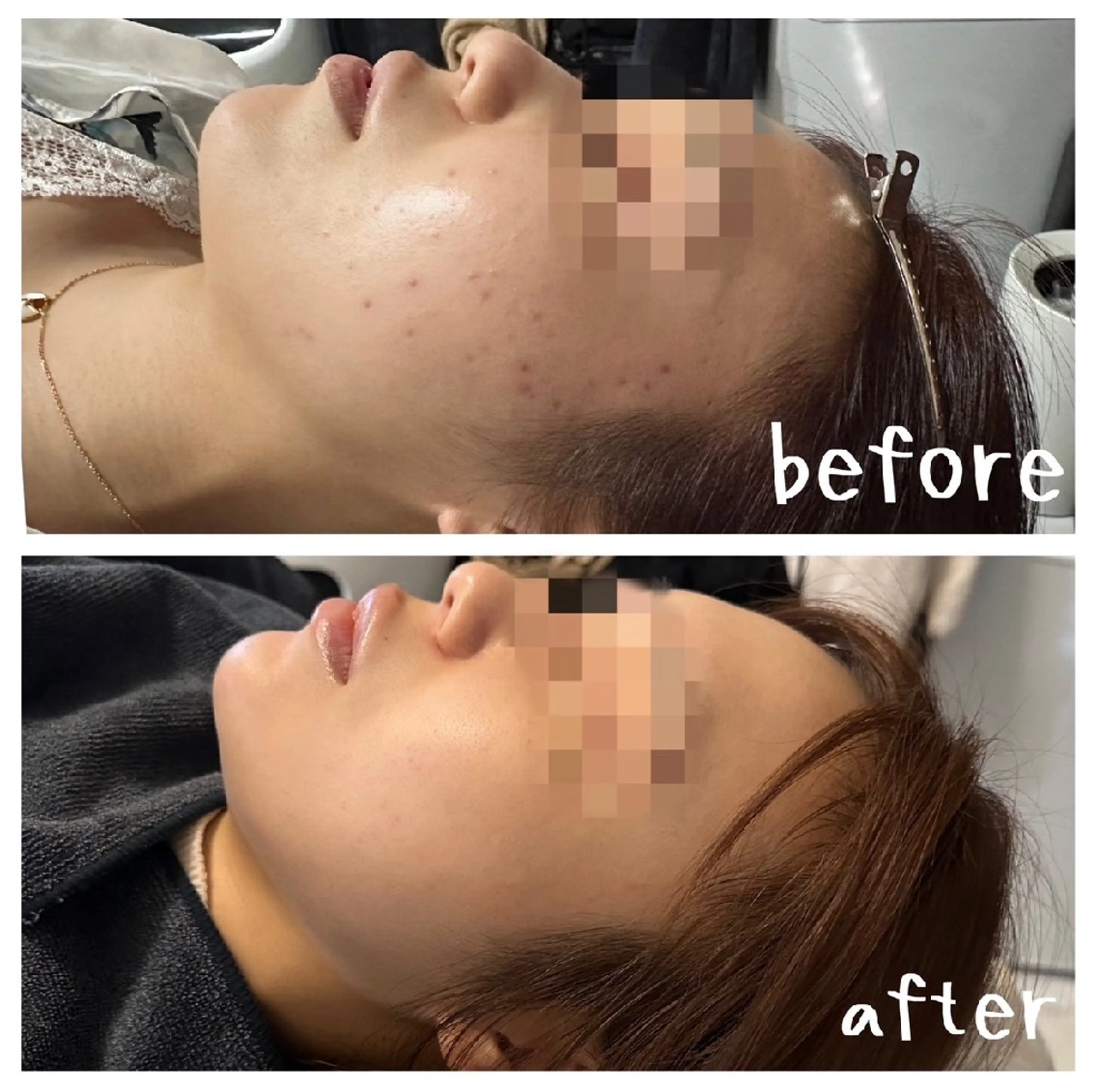 本日限定セール【毛穴/ニキビ/ニキビ跡に💆♀️】最新針入りハーブピーリングの写真