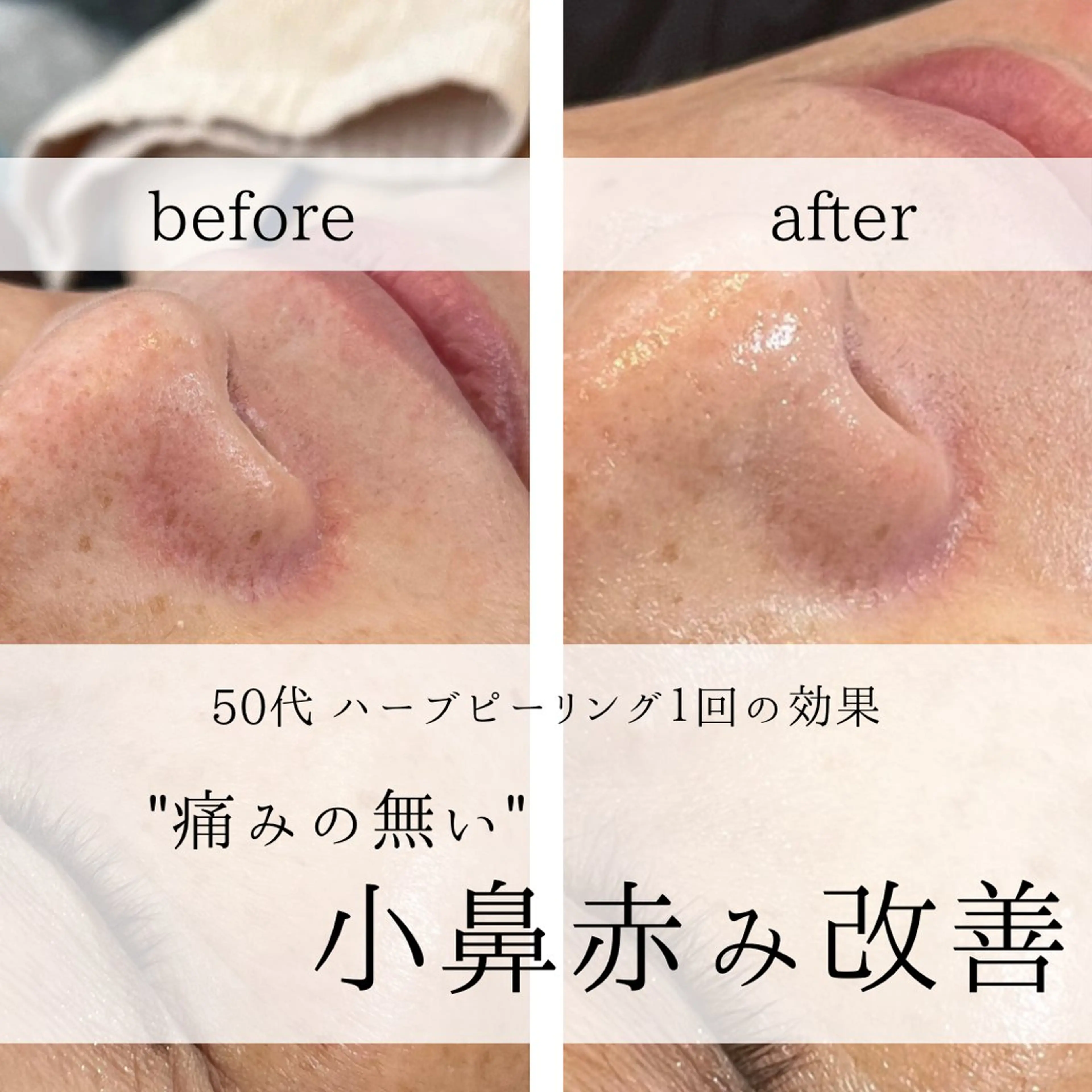 yc.hacci 【ハーブピーリング】の眉毛・アイブロウイメージ