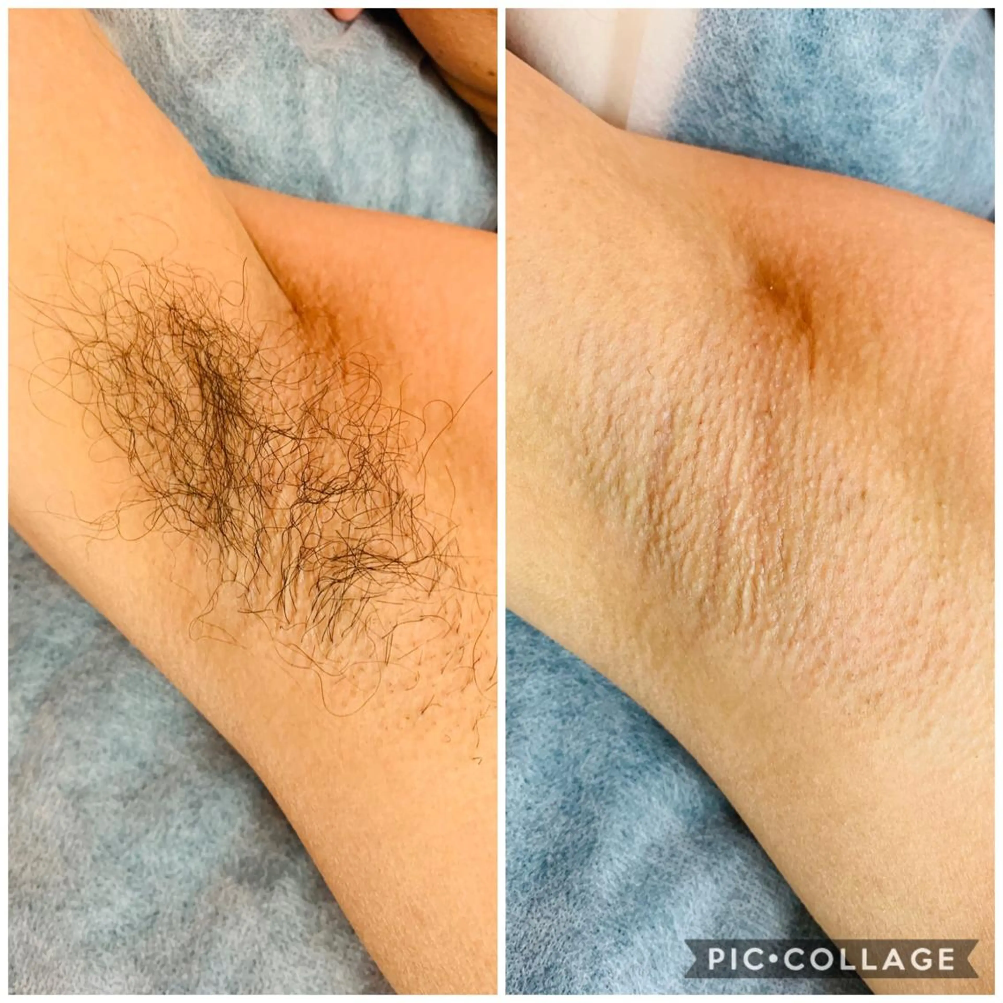 【男性初回】ワキの写真