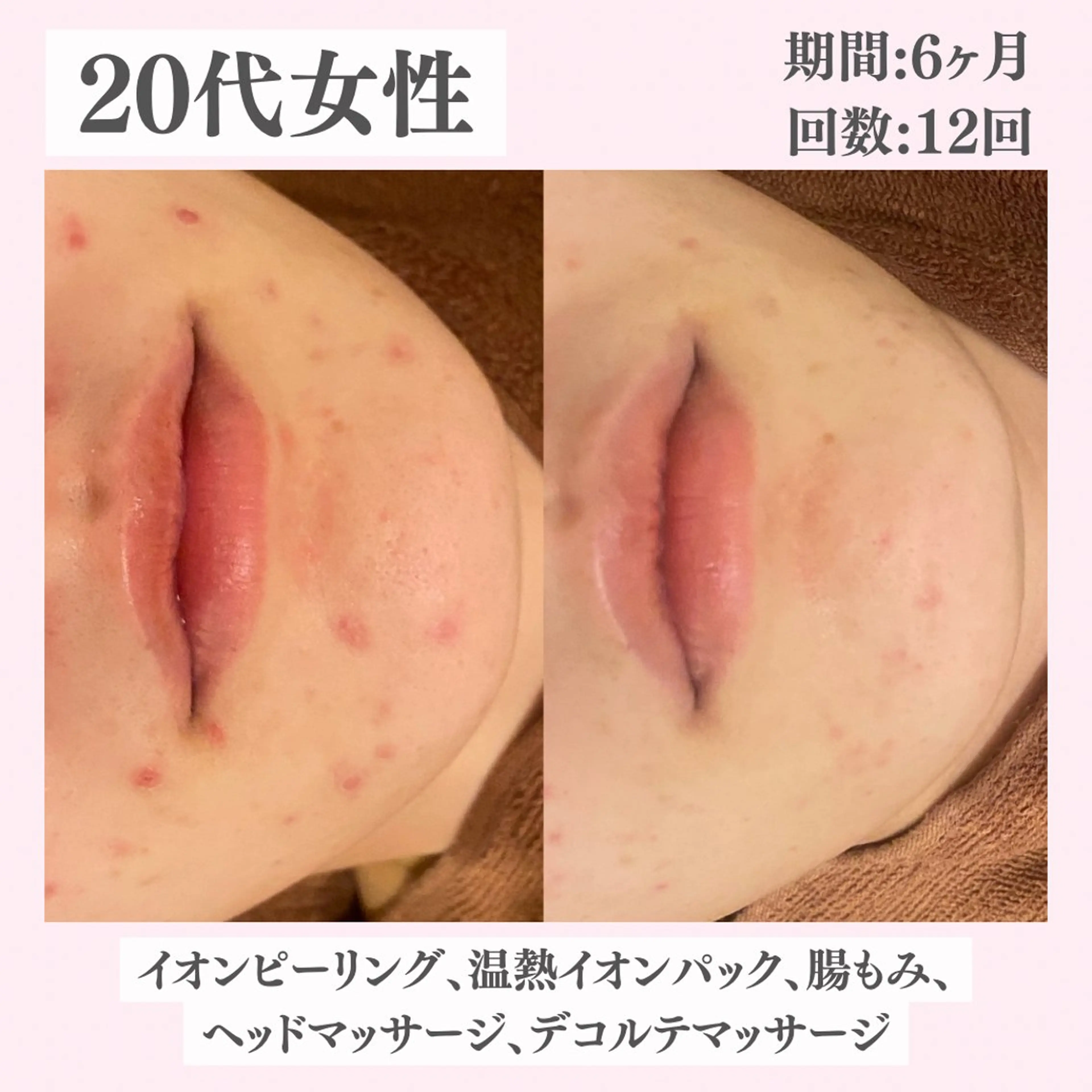 エステ リラク ニキビ・肌質改善専門 ♡人生が変わるサロンのエステ・リラクイメージ