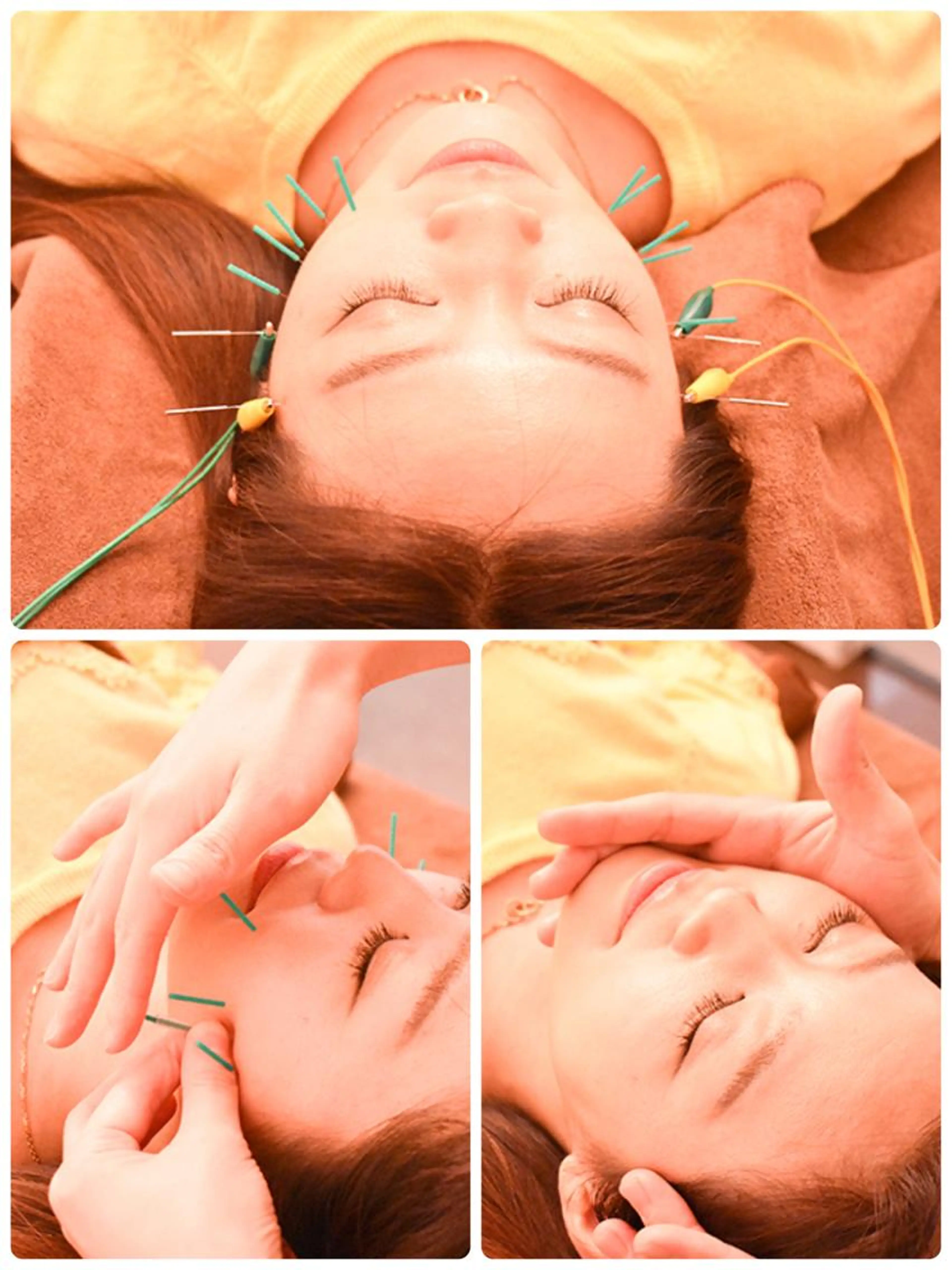 🔥100本美容鍼＋小顔矯正🔥の写真