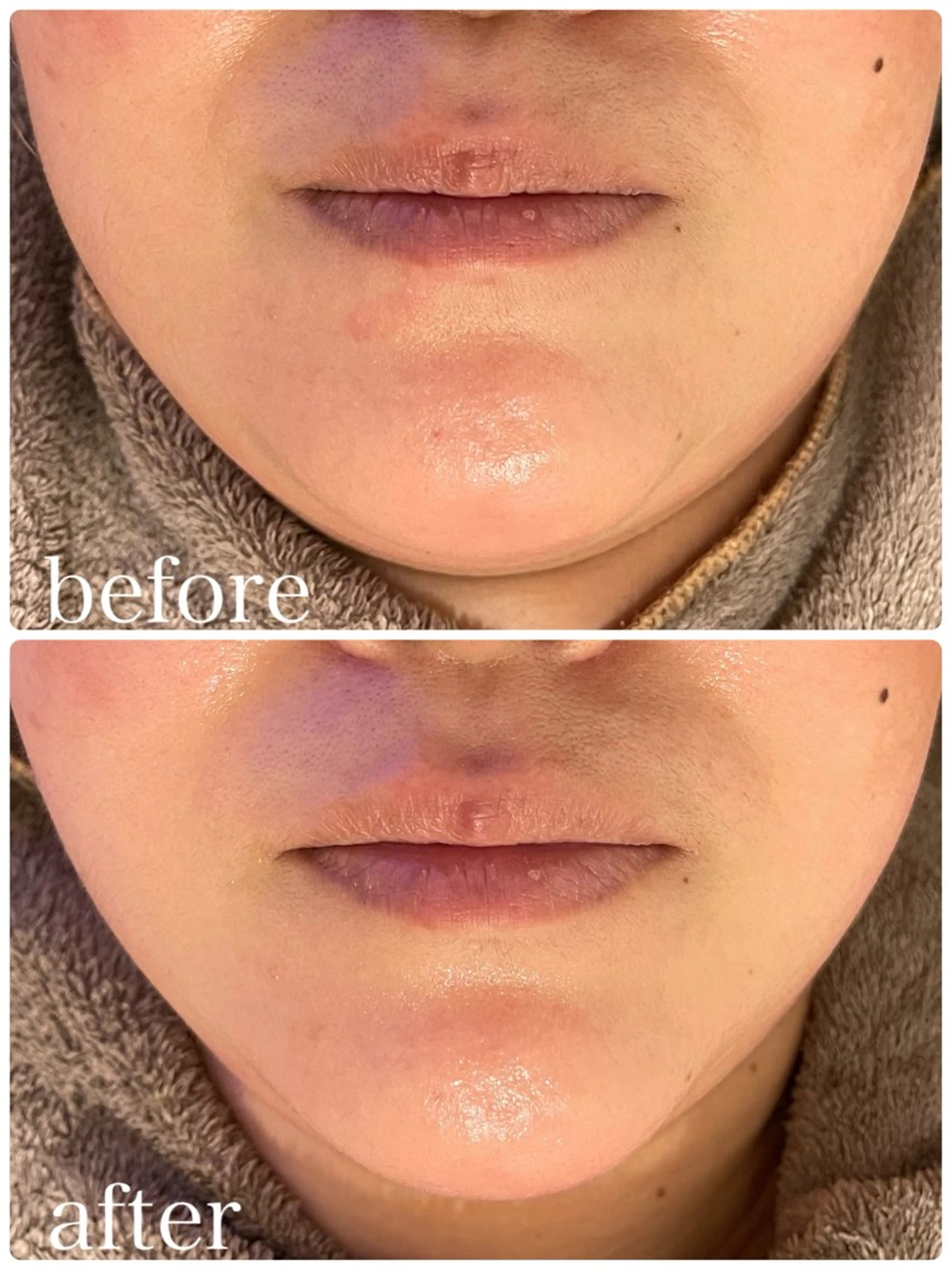 《🍋フェイスラインスッキリケア🍋》フェイスライン/二重アゴ改善に◎※1月限定※の写真